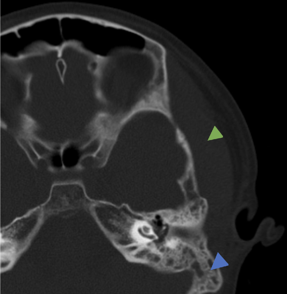 Temporal bone CT. Axial bone window demonstrating mastoid effusion (blue arrowhead) and abnormally thickened left temporal region soft tissues (green arrowhead).
