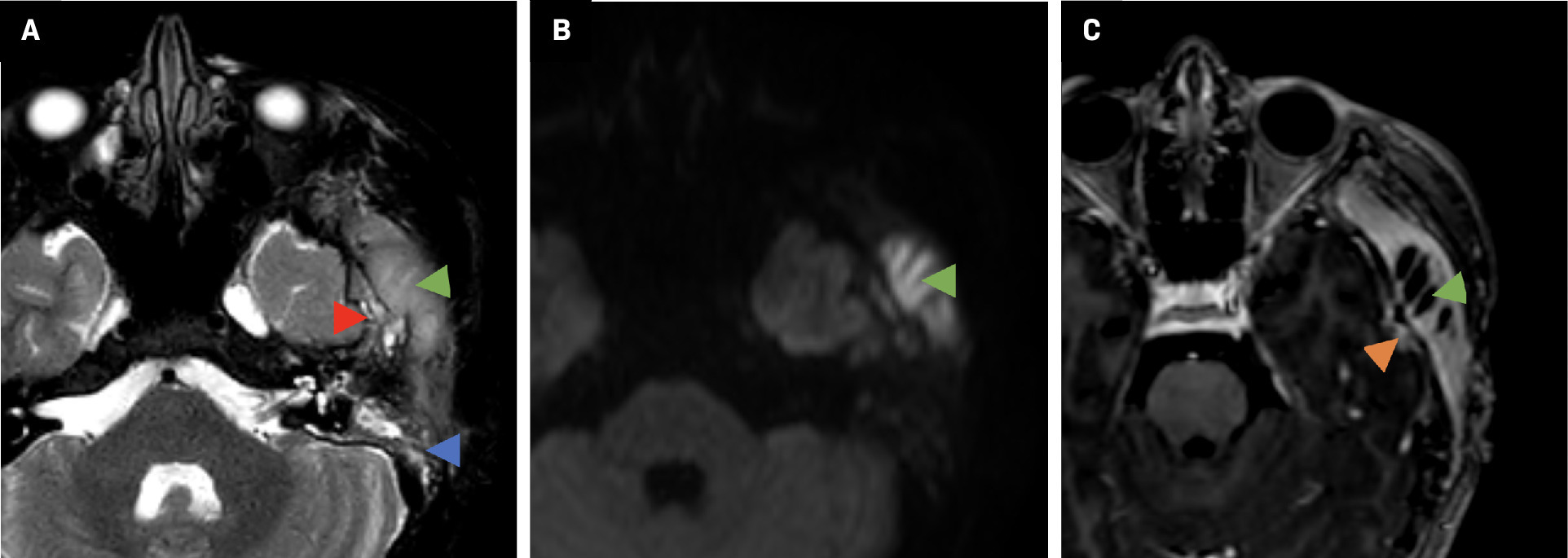Brain MRI. Axial T2 (A) demonstrates mastoid effusion (blue arrowhead), hyperintense thickened left temporal region soft tissues (green arrowhead), and irregularity of the greater wing of the left sphenoid and squamous temporal bone (red arrowhead). (B) Diffusion-weighted imaging demonstrates left temporal scalp collection with increased signal (green arrowhead) and decreased ADC (apparent diffusion coefficient) (not shown) indicating restricted diffusion in the abscess. (C) Postcontrast T1 demonstrates left temporal scalp fluid collection consistent with abscess (green arrowhead) and a small focus of pachymeningeal enhancement along the temporal lobe surface (orange arrowhead).