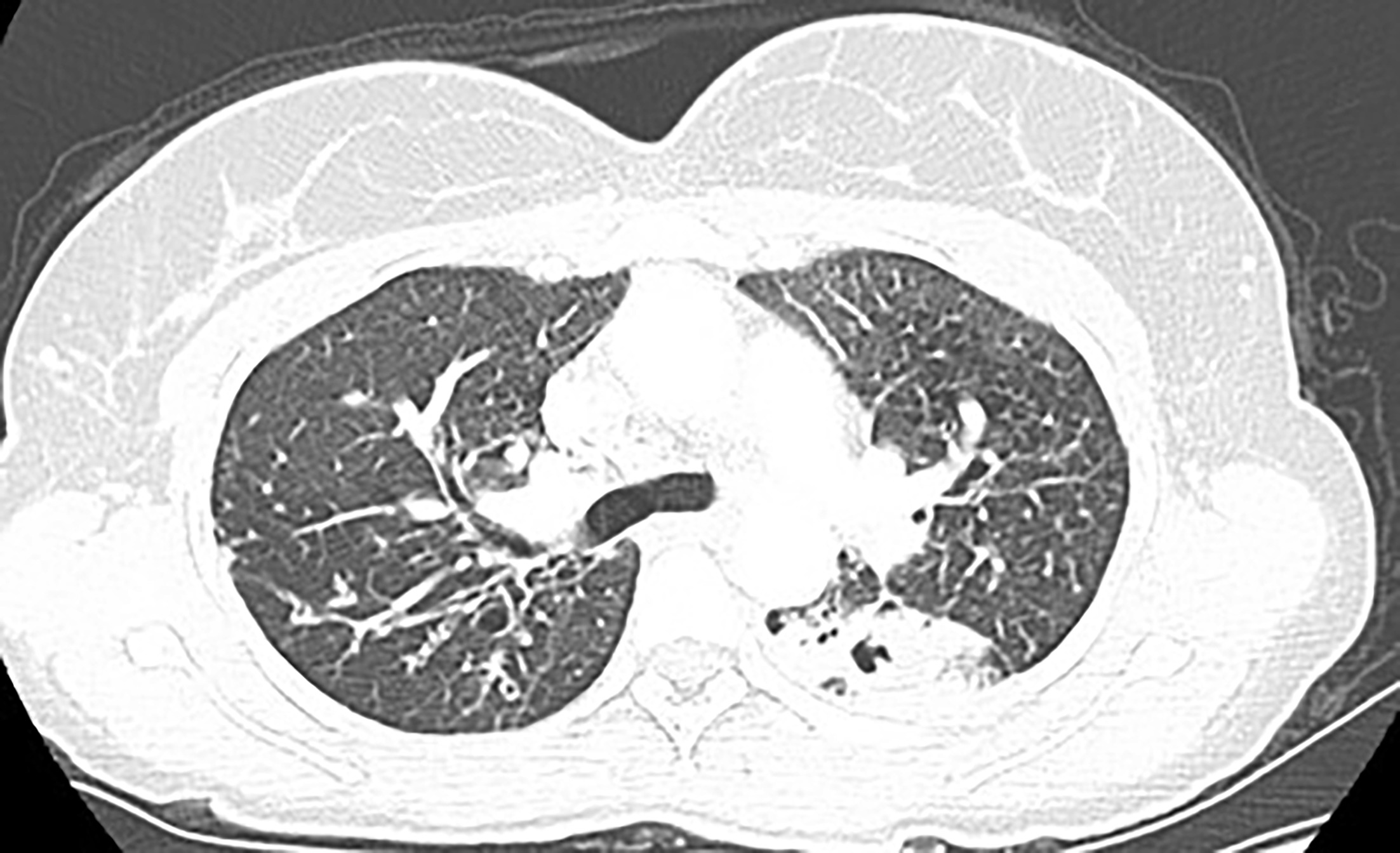 Axial CTA chest lung windows demonstrating thick-walled cavitation of the lower left lung apical segment.