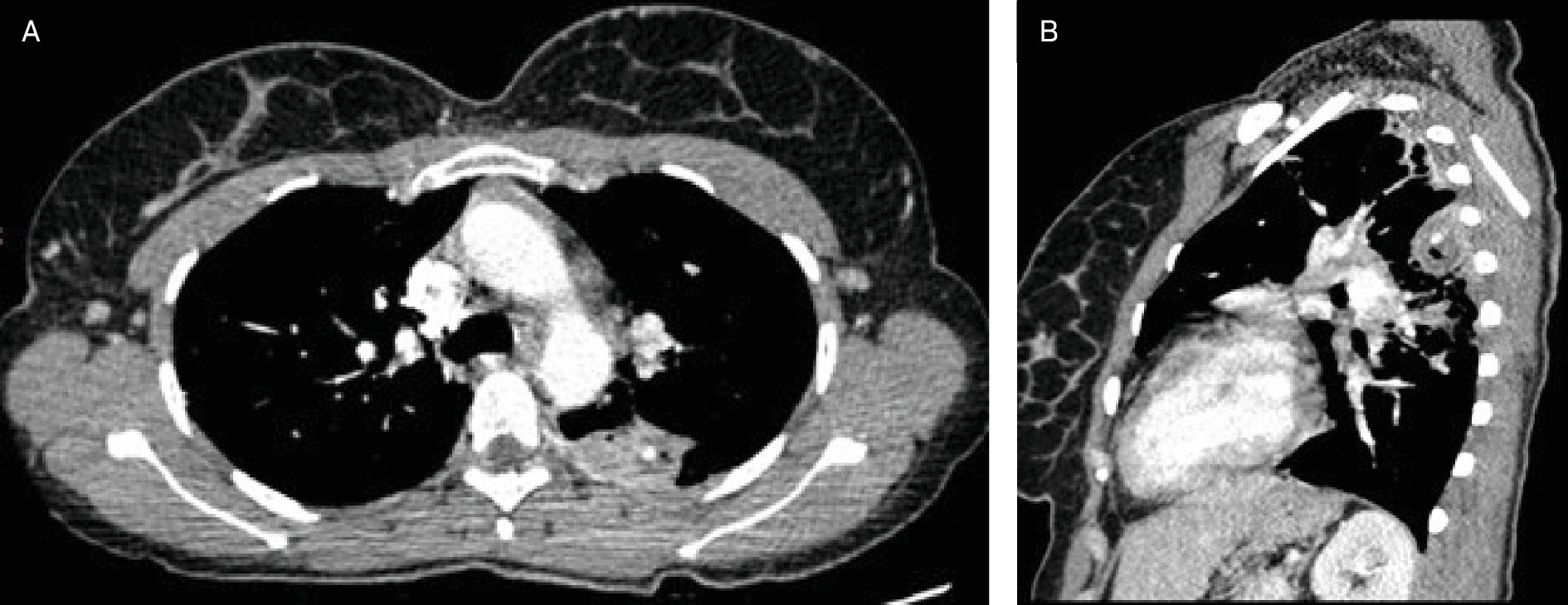 CTA Chest, mediastinal window. (A) Axial view demonstrating a lesion with an internal 6 mm nodular focus of high attenuation. (B) Sagittal view demonstrating a pleural-based lesion with both a focus of air and a nodular focus of high attenuation.