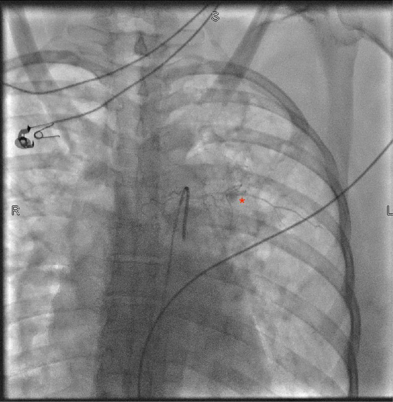 Descending thoracic aortogram demonstrating a T5 intercostal pseudoaneurysm marked by the red asterisk.