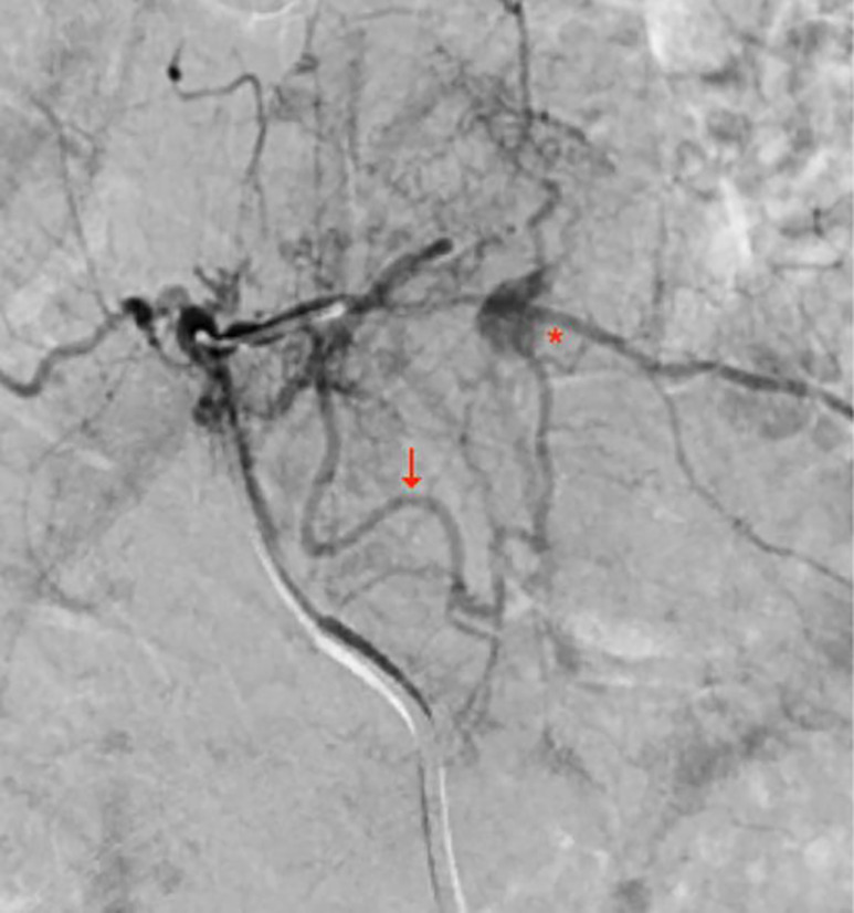 Selective T5 intercostal arteriogram. The pseudoaneurysm (red asterisk) is visualized, with the main (red arrow) and multiple secondary feeding vessels arising from the T5 proximal intercostal artery.