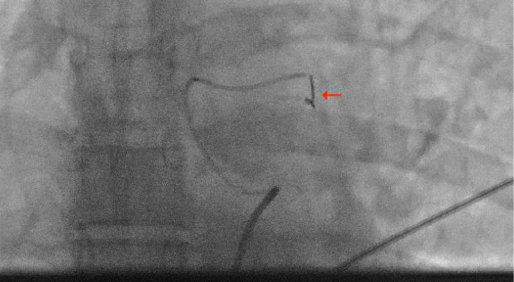 Super-selective 2 mm x 1 cm Ruby microcoil (red arrow) deployment within the inferiorly projecting feeder branch.