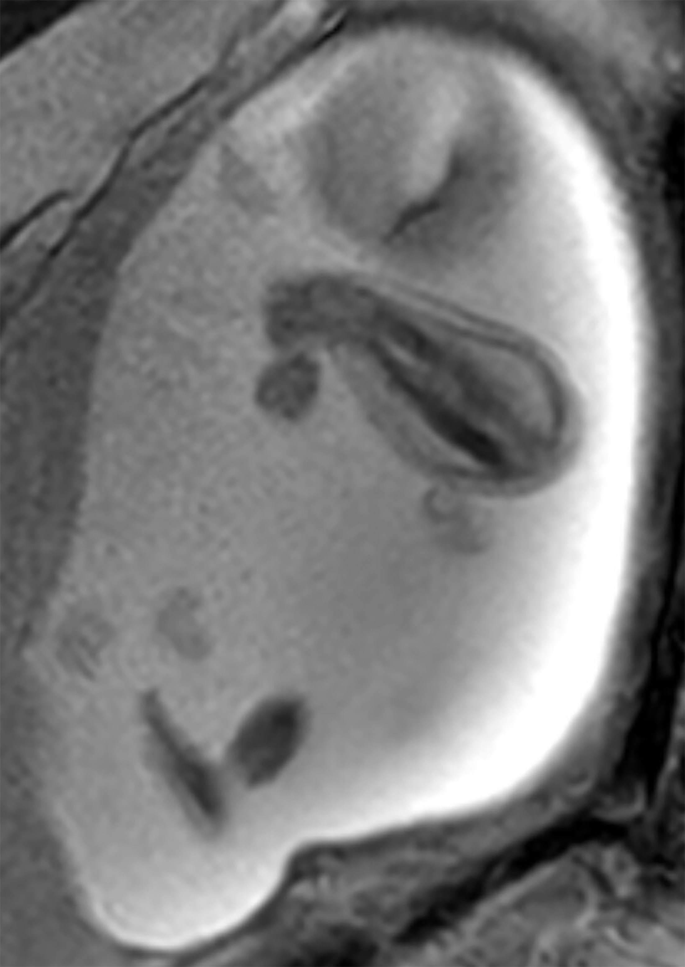 Sagittal T2-weighted fetal MRI demonstrates enlargement of the right forearm soft tissues with thickening of the radius and ulna.