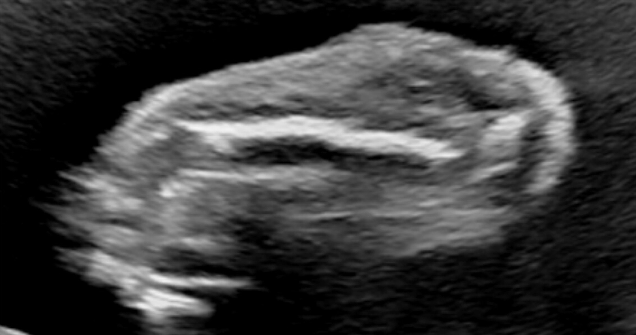 Coronal US confirms soft tissue enlargement of the right forearm and bony enlargement without associated fluid collection.