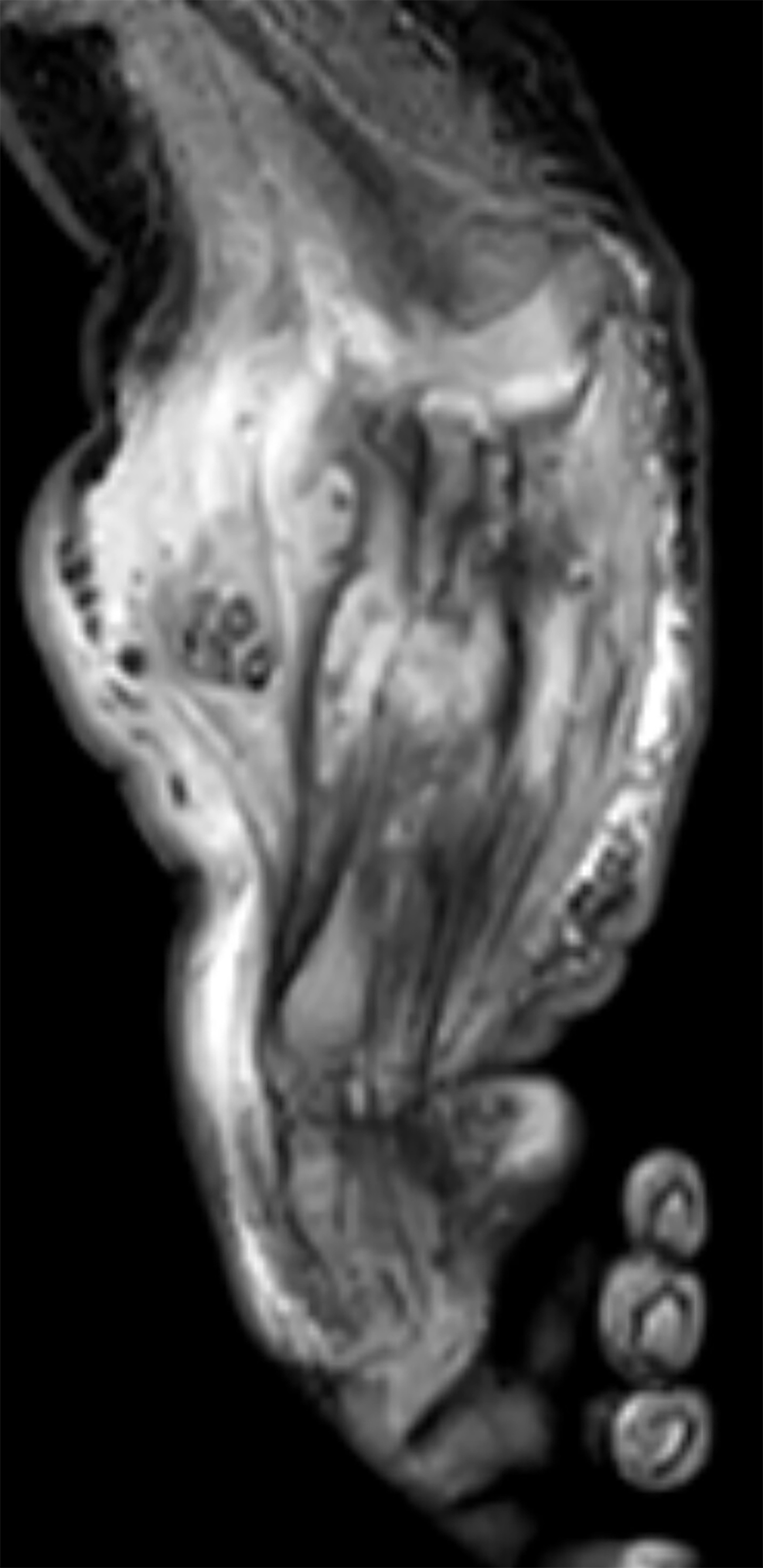 Sagittal T2-weighted MRI demonstrates further enlargement of the forearm, irregular contouring of the radius and ulna, and dystrophic soft tissue calcifications 4 days after birth.