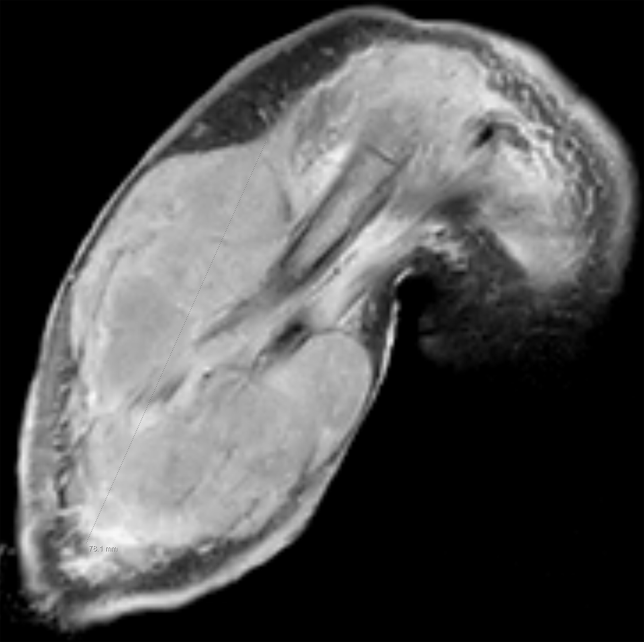 Coronal T2-weighted MRI demonstrates a lobulated, circumferential, enhancing soft tissue mass surrounding the mid humerus without obvious bony involvement of the proximal humerus at 5 months. Additionally, a fluid collection of the distal arm near the amputation stump is present.
