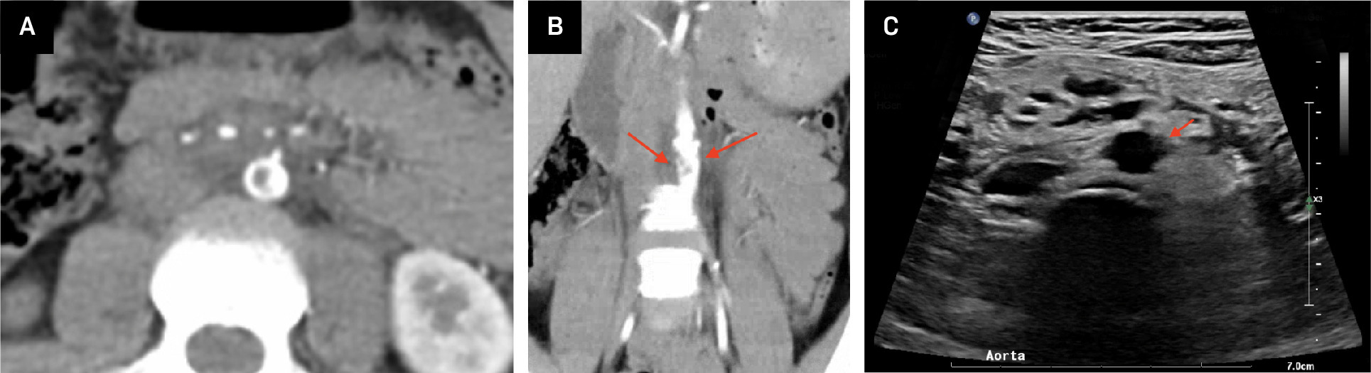 (A) Axial CT demonstrates a contained aortic rupture. An intraluminal filling defect is present with adjacent periaortic fat stranding and displacement of adjacent structures, suggesting some mass effect from hematoma. (B) Coronal CT demonstrates the abdominal aortic defect, with intraluminal filling defects shown by red arrows. Luminal wall irregularity is also present. Inhomogeneity of the periaortic fat is also present. (C) Transverse grayscale ultrasound image of the abdominal aorta demonstrates abdominal aortic wall irregularity (shown by red arrow) and periaortic hematoma. Lack of normal retroperitoneal fat.