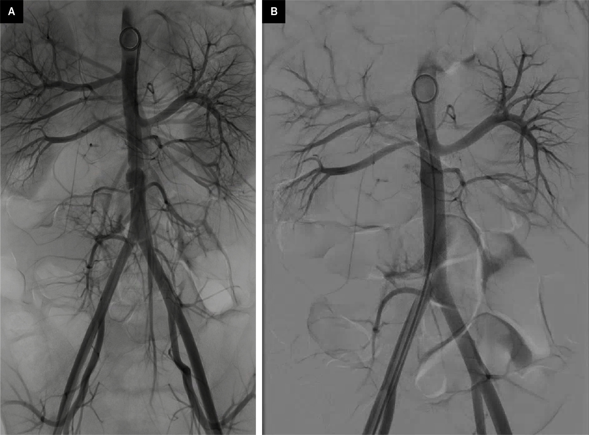 (A) Pigtail aortogram demonstrates mid-aortic irregularity just above the take-off of the inferior mesenteric artery (IMA) pre-stent placement. Dissection flap present with luminal narrowing of the abdominal aorta. (B) Aortogram post-stent placement demonstrates normal wall appearance of the mid-aorta. The origins of the renal arteries are preserved, and the origin of the IMA is excluded.