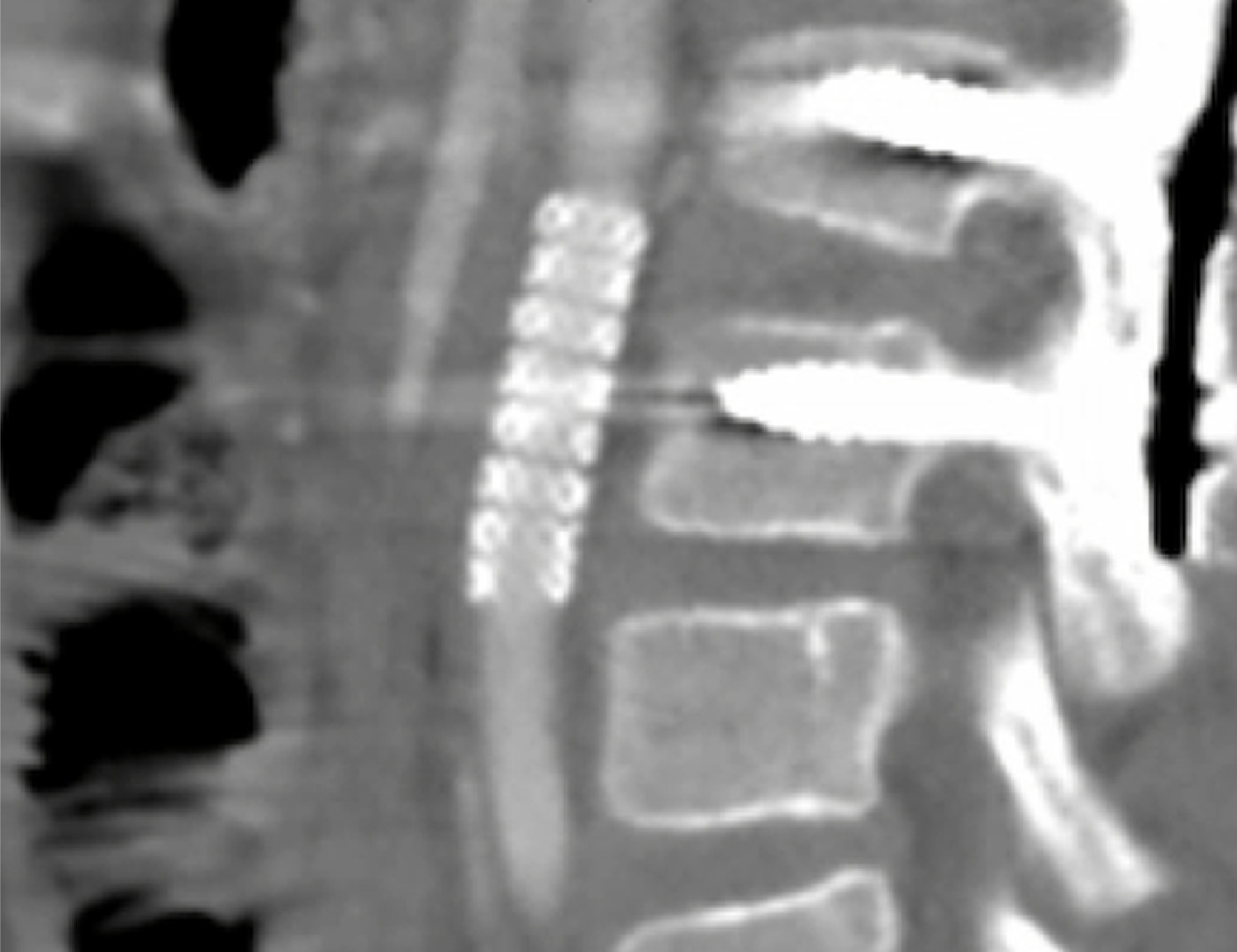 Sagittal post-contrast CT abdomen shows the stent graft unchanged in position without aneurysm, significant stenosis, or occlusion at a 5-month follow-up. Abdominal aortic caliber remains preserved. No stent fracture or defect noted.