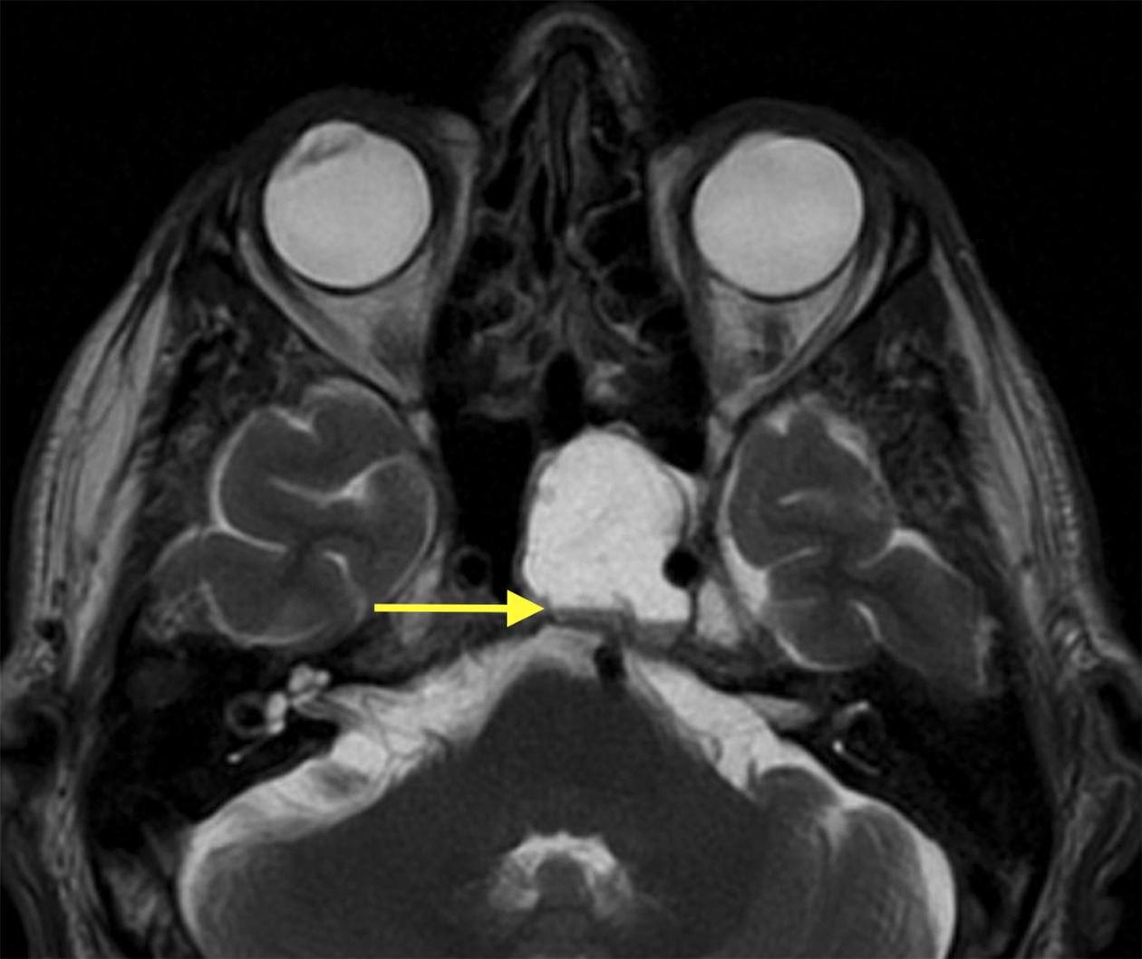 T2 FLAIR MRI demonstrating a well-circumscribed expansile mass in the left sphenoid sinus with a blood-fluid level (arrow) and T2 hyperintensity.