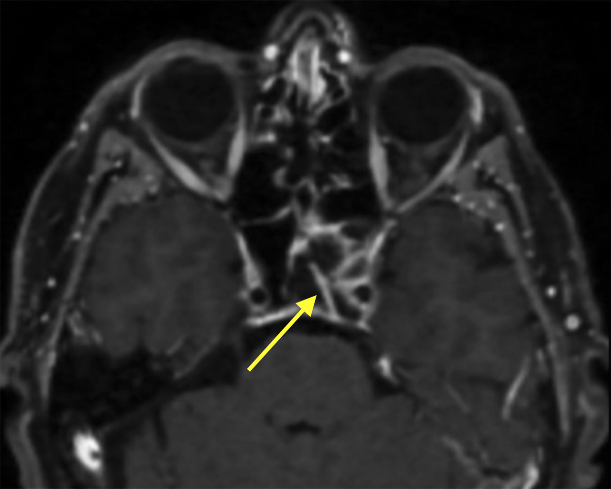 Postcontrast T1WI demonstrating lateral extension of the mass to partially encompass the left cavernous intracranial carotid artery. There is also thinning of the clivus without intracranial extension dorsally.