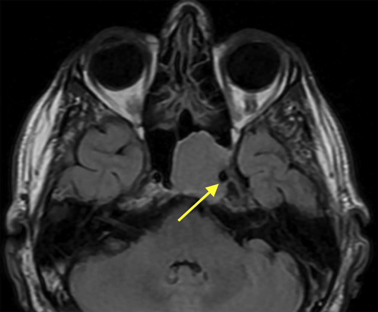 Postcontrast T1 image demonstrating peripheral enhancement with thin linear enhancement along the superior aspect. No nodular enhancement is noted.