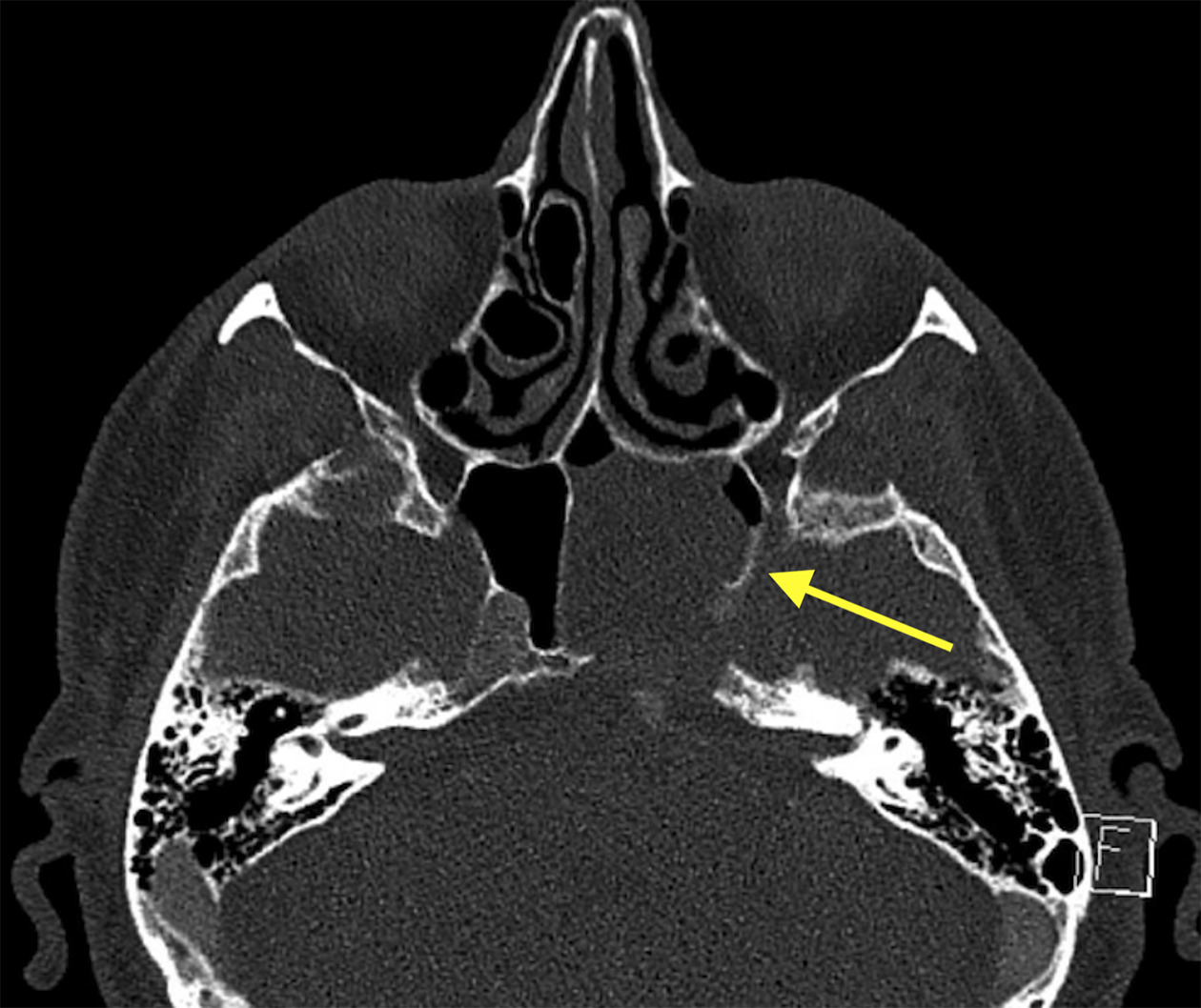 Sinus CT scan demonstrating osseous erosions of the clivus and lateral sphenoid sinus wall.