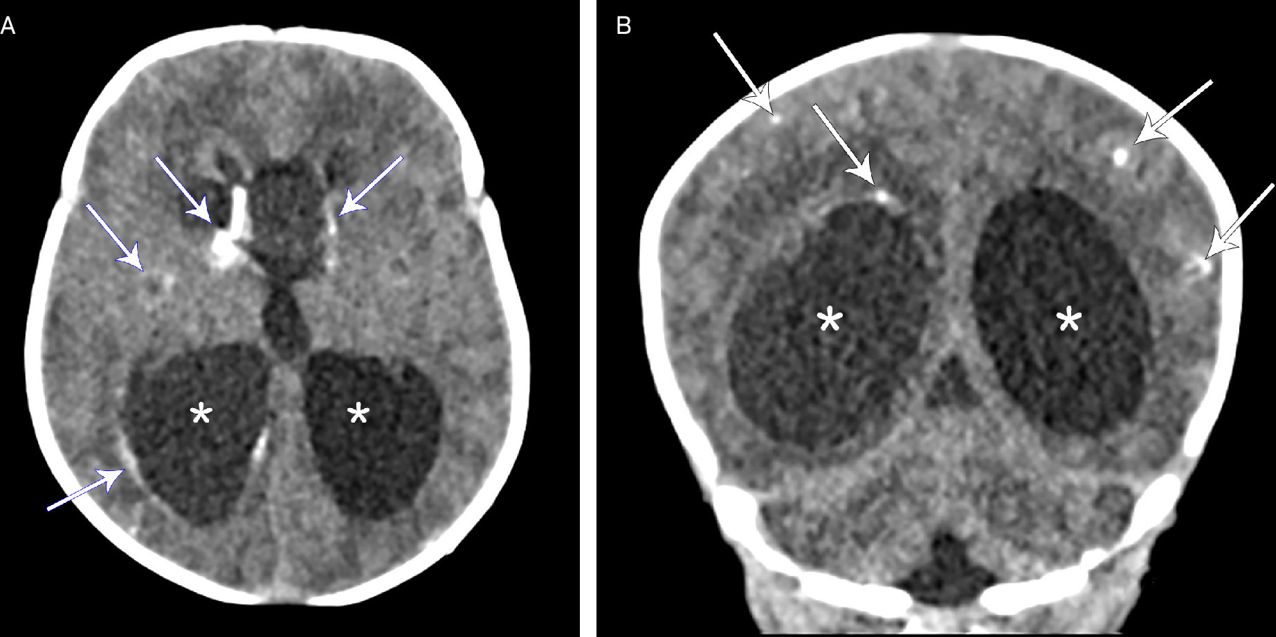 Axial (A) and coronal (B) head CT scans demonstrating hydrocephalus (*) and extensive parenchymal calcifications (white arrows), including basal ganglia, subcortical, and periventricular calcifications.