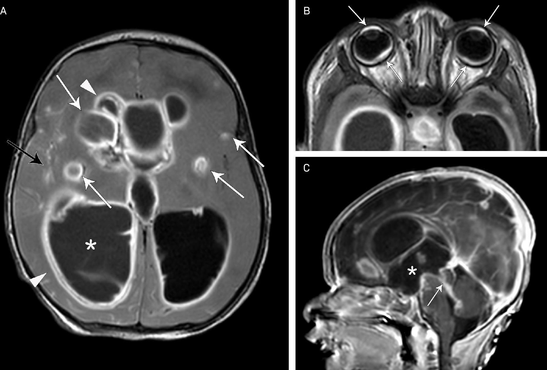 Axial post-gadolinium T2 FLAIR MRI of the brain (A) demonstrating hydrocephalus with incomplete suppression of signal in the intraventricular CSF (*), multifocal enhancing parenchymal lesions in the basal ganglia and subcortical white matter (white arrows), leptomeningeal enhancement (black arrow), and thick ependymal enhancement (arrowheads). Axial image at a more inferior level from the same sequence (B) demonstrating enhancing, plaque-like, intraocular thickening in the anterior and posterior segments (arrows). Sagittal postcontrast T1 MRI (C) demonstrating dilatation of the third ventricle with dilated third ventricular recesses (*) and aqueductal stenosis with thick ependymal enhancement (arrow).