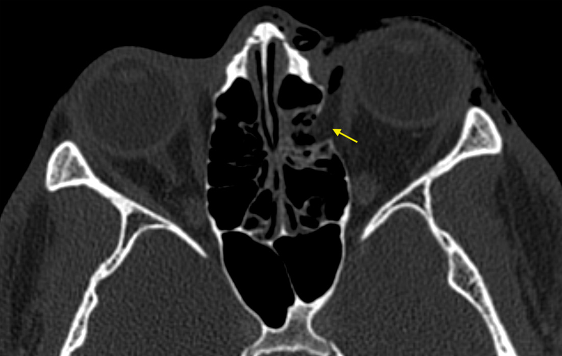 Axial bone window CT demonstrating a left medial orbital wall blowout fracture with herniation of orbital fat (arrow) and mild left proptosis. No extraocular muscle entrapment is seen.