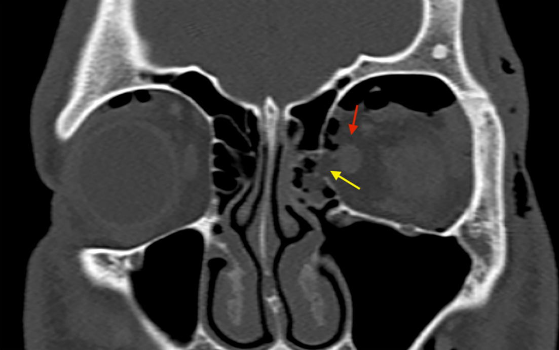Coronal bone window CT with redemonstrated fracture defect in the left medial orbital wall with herniation of intraconal fat (yellow arrow). The left medial rectus is contained within the orbit (red arrow).