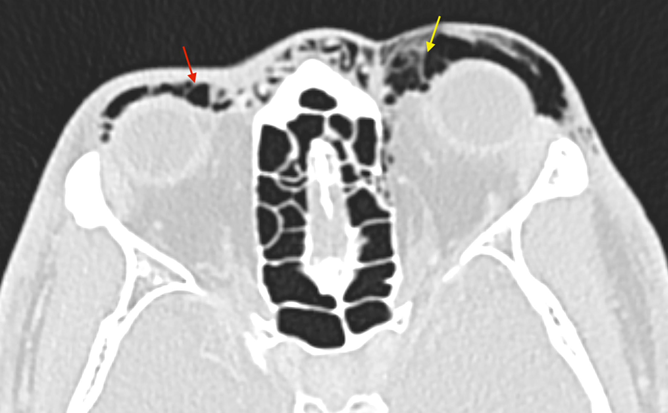 Axial lung window CT reveals left-sided orbital emphysema, which is seen tracking from the fracture defect along the medial orbital wall to the left preseptal space (yellow arrow). Air tracks to the contralateral orbit through the anterior nasal subcutaneous tissues (red arrow).