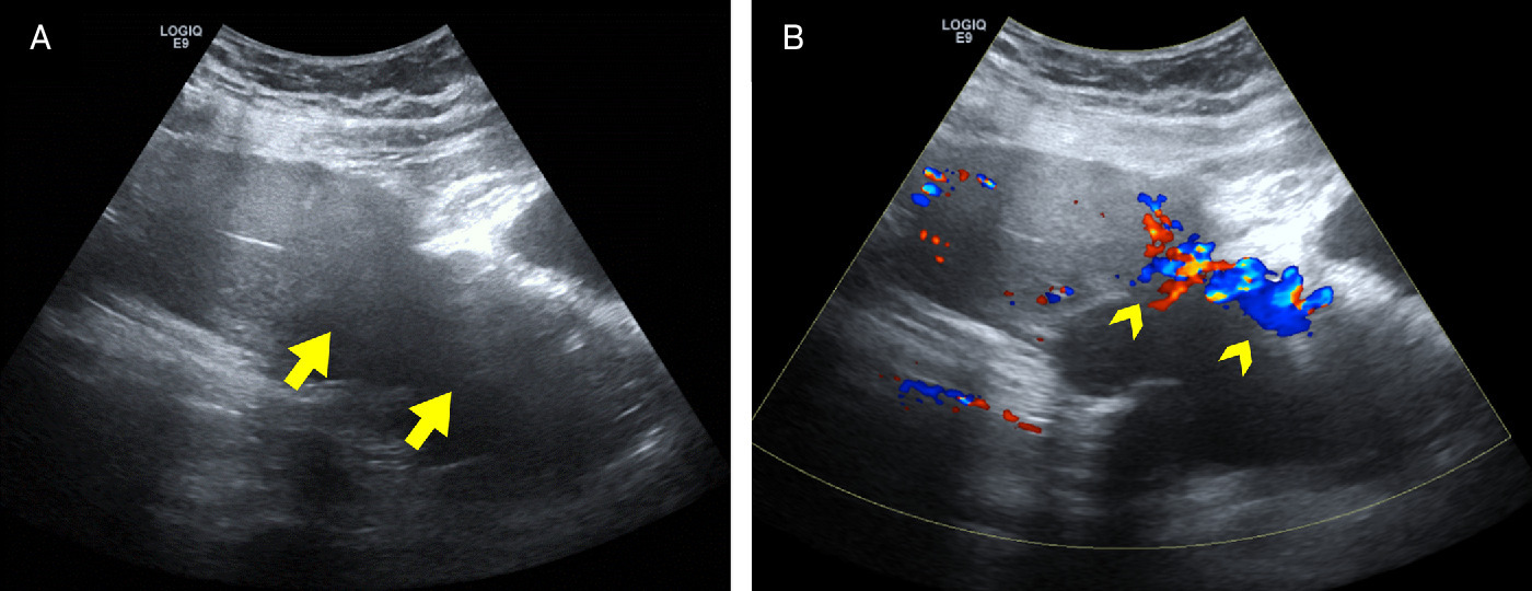 (A) Grayscale transabdominal US image in the sagittal plane reveals a poorly defined, hypoechoic mass (arrows) with posterior shadowing in the cervix. (B) Color Doppler image demonstrates significant vascularity (arrowheads).