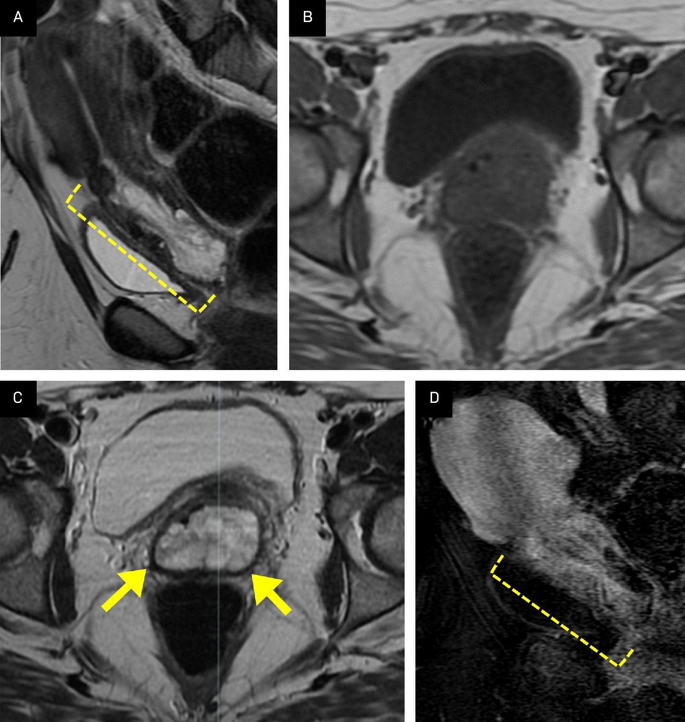 (A) Sagittal T2 sequence demonstrates a high water-content mass (bracket) protruding from the endocervical canal into the vaginal cavity. (B, C) Axial images show a T1 hypointense, T2 hyperintense mass with a thin rim of vaginal tissue (arrows). (D) T1 post-contrast subtraction images reveal heterogeneous contrast enhancement of the mass (bracket).