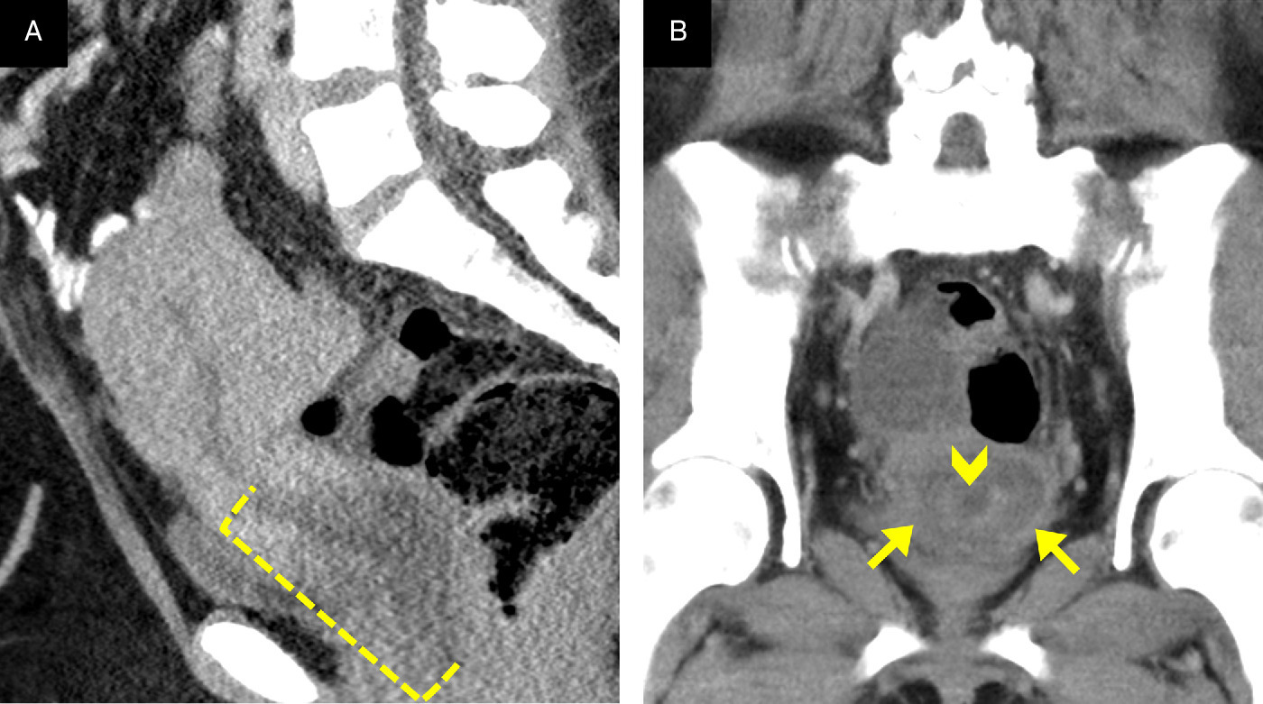 (A) Sagittal contrast-enhanced CT images demonstrate the low-density endocervical mass (bracket) with extension into the vaginal cavity. (B) Coronal images demonstrate the endocervical component of the mass (arrowhead) with surrounding dilated cervical tissue (arrows).