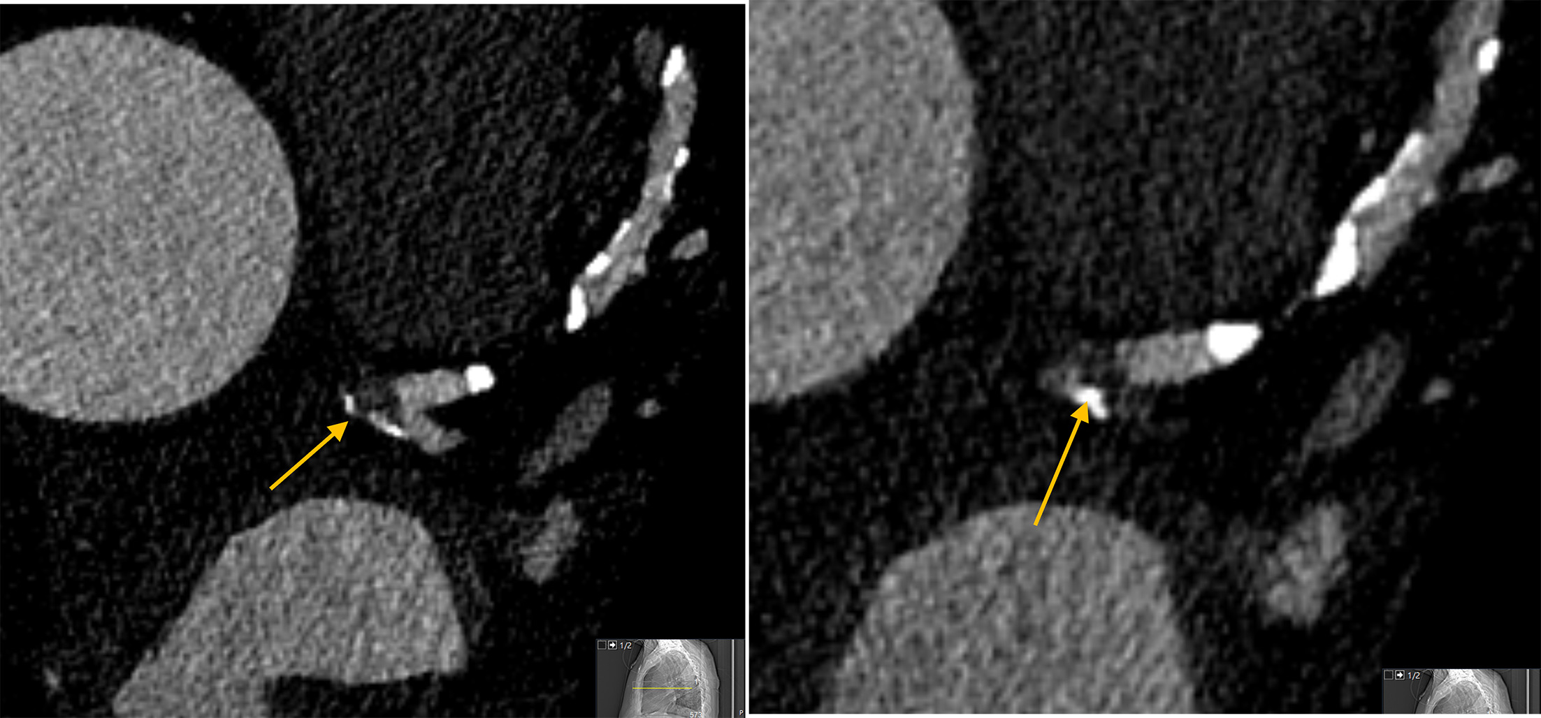 Photon-counting CT reduces blooming artifact from coronary calcium. Photon-counting detector CT with ultra-high-resolution acquisition (left, 0.2 mm ultra-high-resolution [UHR], Bv56u kernel) depicts distal left main bifurcation plaque with sharply defined calcified components and preserved visualization of the true lumen extending into the proximal left anterior descending and left circumflex arteries, minimizing calcium blooming. In contrast, a standard-resolution photon-counting detector CT acquisition without UHR mode (right) demonstrates more pronounced blooming of the same calcified plaque, obscuring the residual lumen and leading to overestimation of stenosis severity and potential up-classification of Coronary Artery Disease-Reporting and Data System (CAD-RADS).