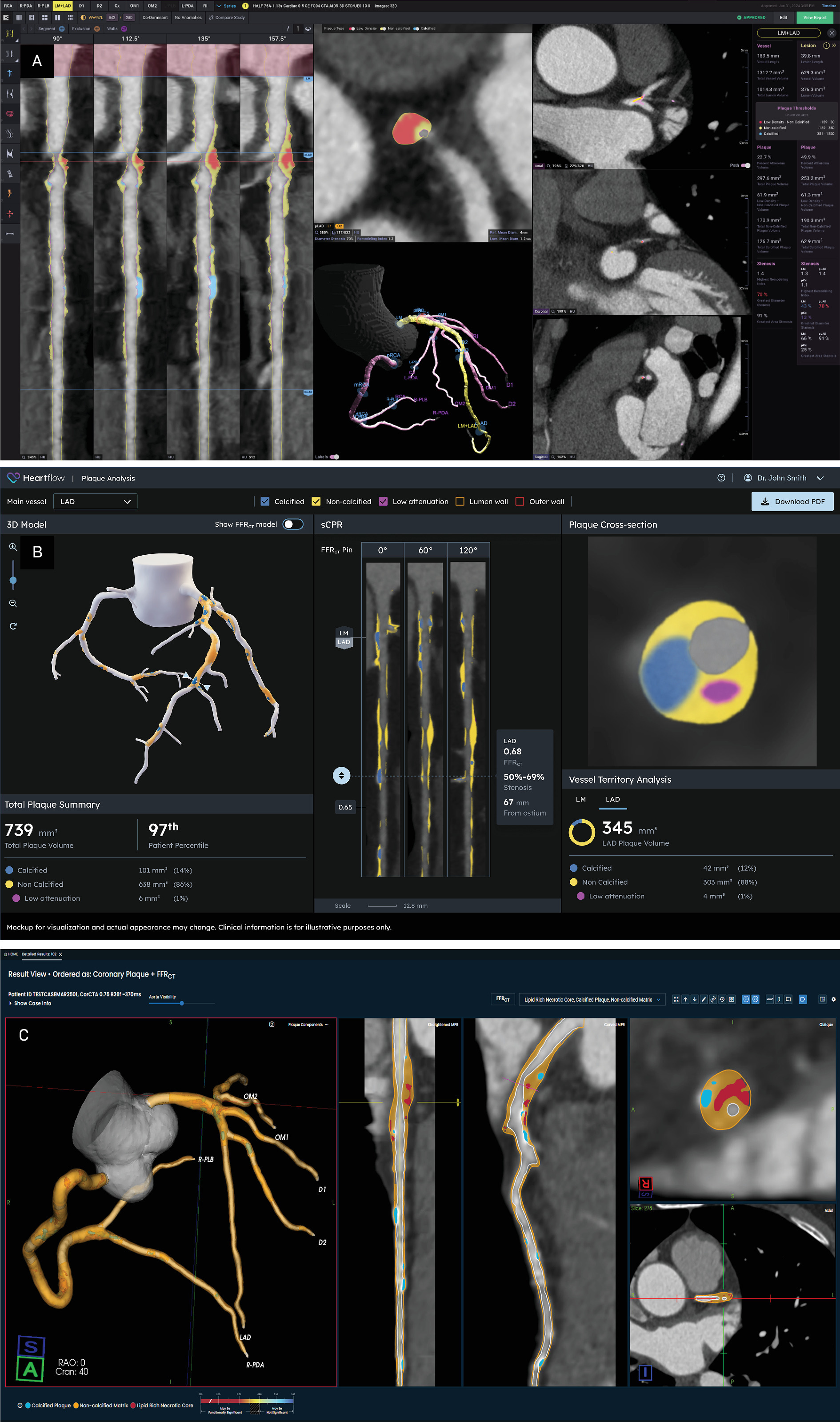 Interactive browser with analytic tools for in-depth vessel- and plaque-level analysis from each vendor. (A) Cleerly, (B) HeartFlow, and (C) Elucid. Images are reproduced with permission from Cleerly, Inc, HeartFlow, and Elucid.