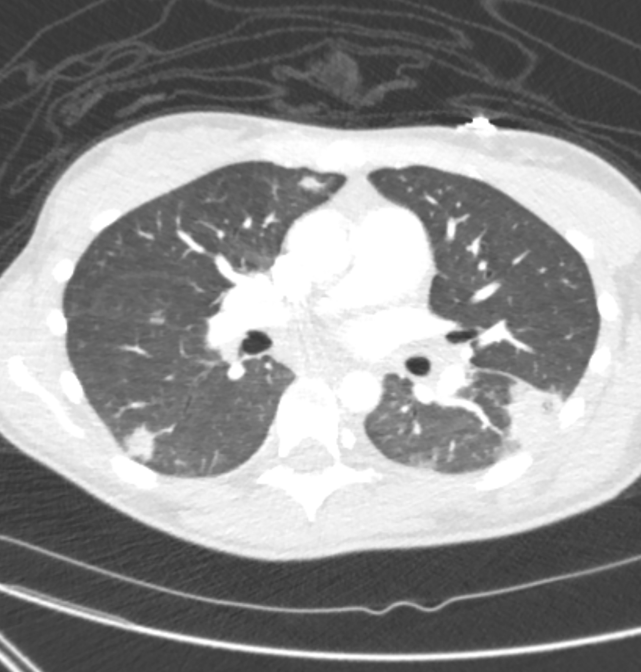Axial chest CT demonstrating multiple bilateral cavitating and consolidative lung lesions, consistent with septic emboli.