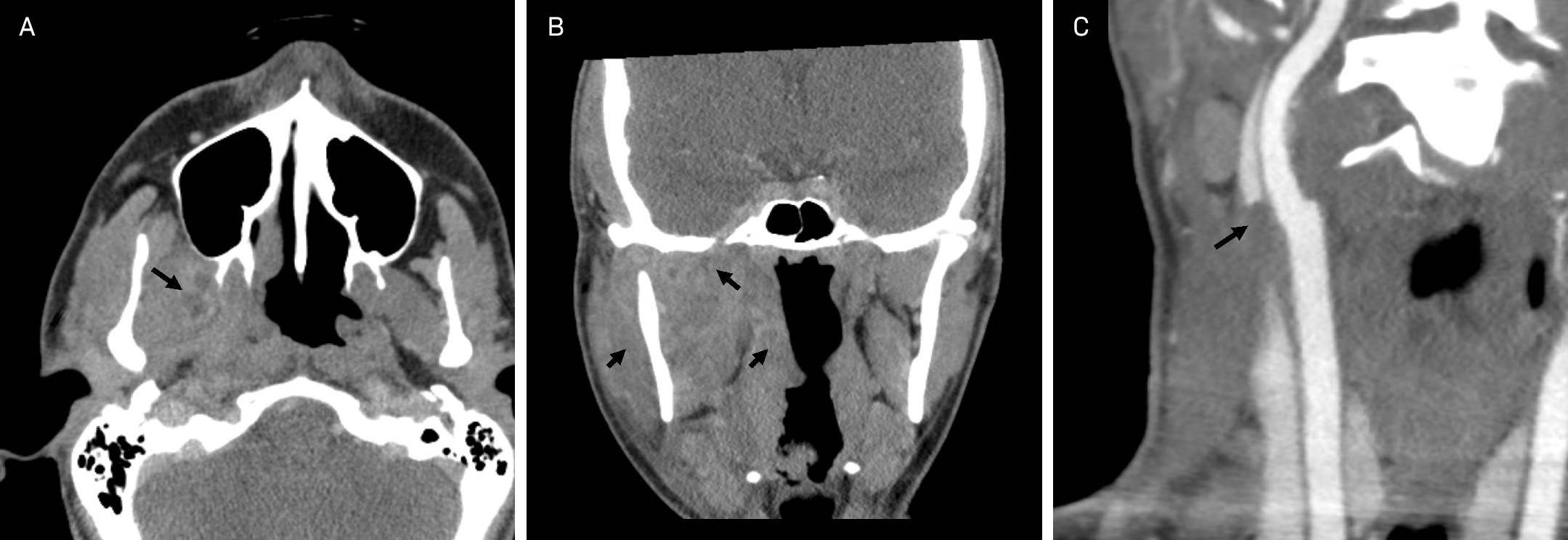 Axial (A) and coronal (B) CT neck demonstrating phlegmon and inflammatory changes involving the right masticator space, right pharyngeal mucosal space, and right parapharyngeal space (black arrows). CT angiogram (C) curved reformat showed filling defect of the right internal jugular vein (black arrow).