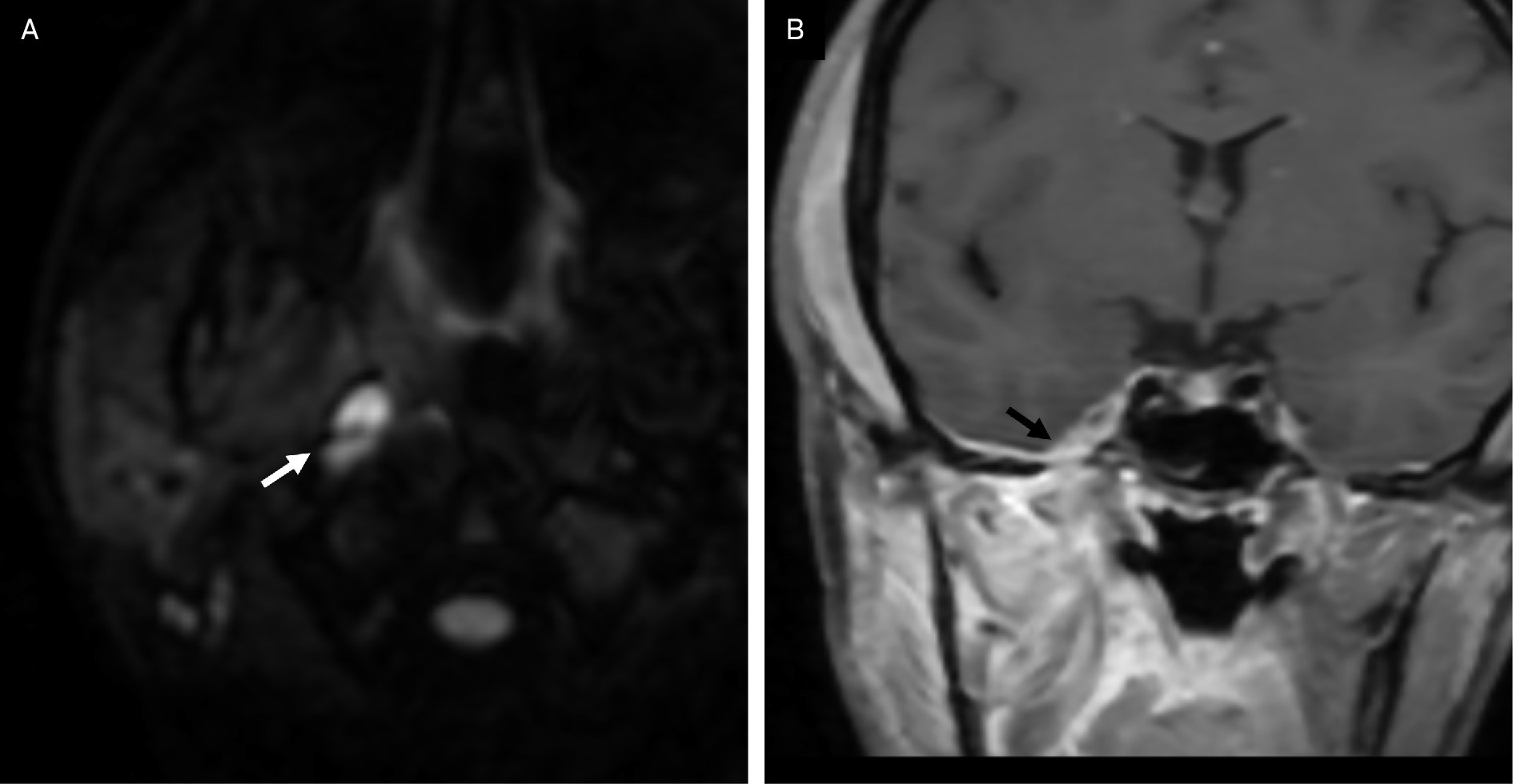 Axial diffusion-weighted MRI (A) revealing a small collection with restricted diffusion in the right parapharyngeal space (white arrow), compatible with an abscess. Coronal post-contrast T1-weighted imaging (B) demonstrating epidural extension along the right middle cranial fossa through the foramen ovale (black arrow).