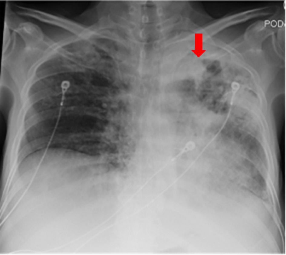 Initial chest radiograph. Diffuse multifocal airspace opacities throughout the left lung with an associated left apical cavitary lesion (red arrow).