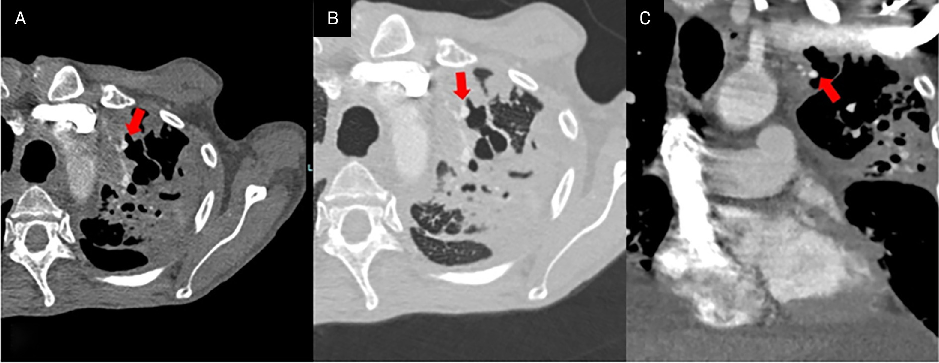 CT pulmonary angiography. Axial soft tissue window (A), axial lung window (B), and coronal soft tissue window (C) images demonstrating a focal saccular aneurysmal outpouching (red arrow) along the anterior segmental branch of the left upper lobe pulmonary artery, consistent with a Rasmussen aneurysm adjacent to the left apical cavitary lesion.
