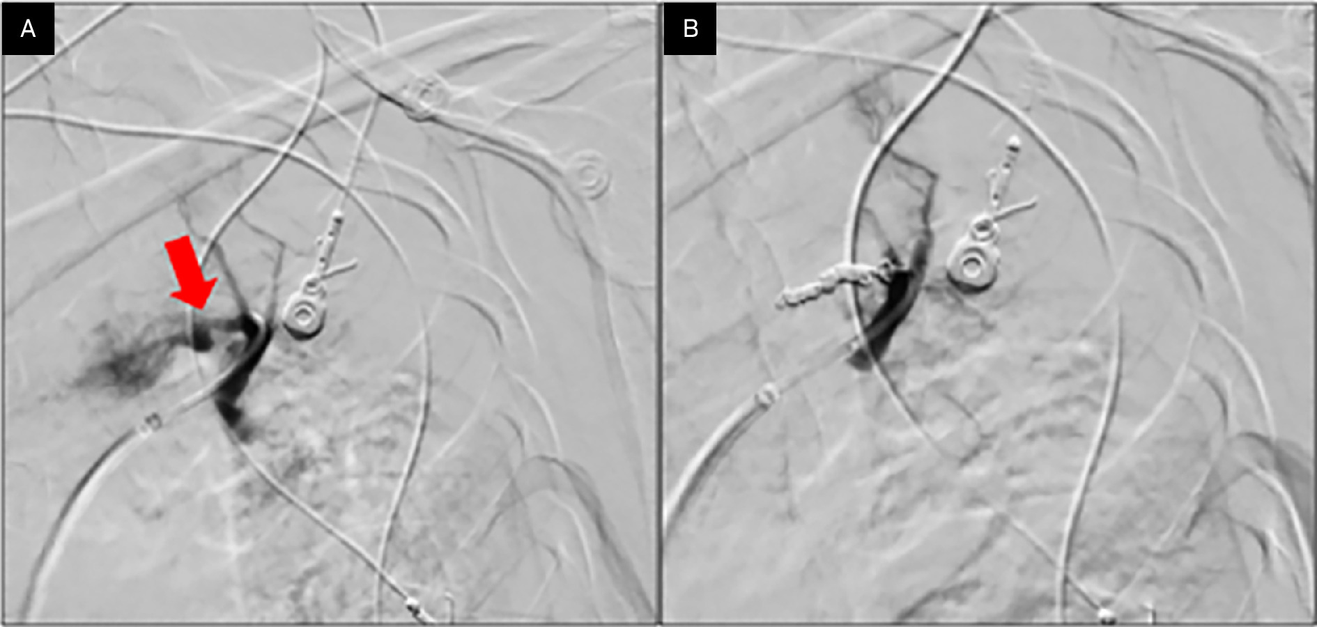 Pulmonary angiography with coil embolization. Digital subtraction angiography of the left pulmonary artery (A) demonstrating a Rasmussen aneurysm (red arrow) involving the anterior segmental branch of the left upper lobe pulmonary artery. Following coil embolization just distal and proximal to the aneurysm (B), no residual contrast filling of the aneurysm sac was noted.
