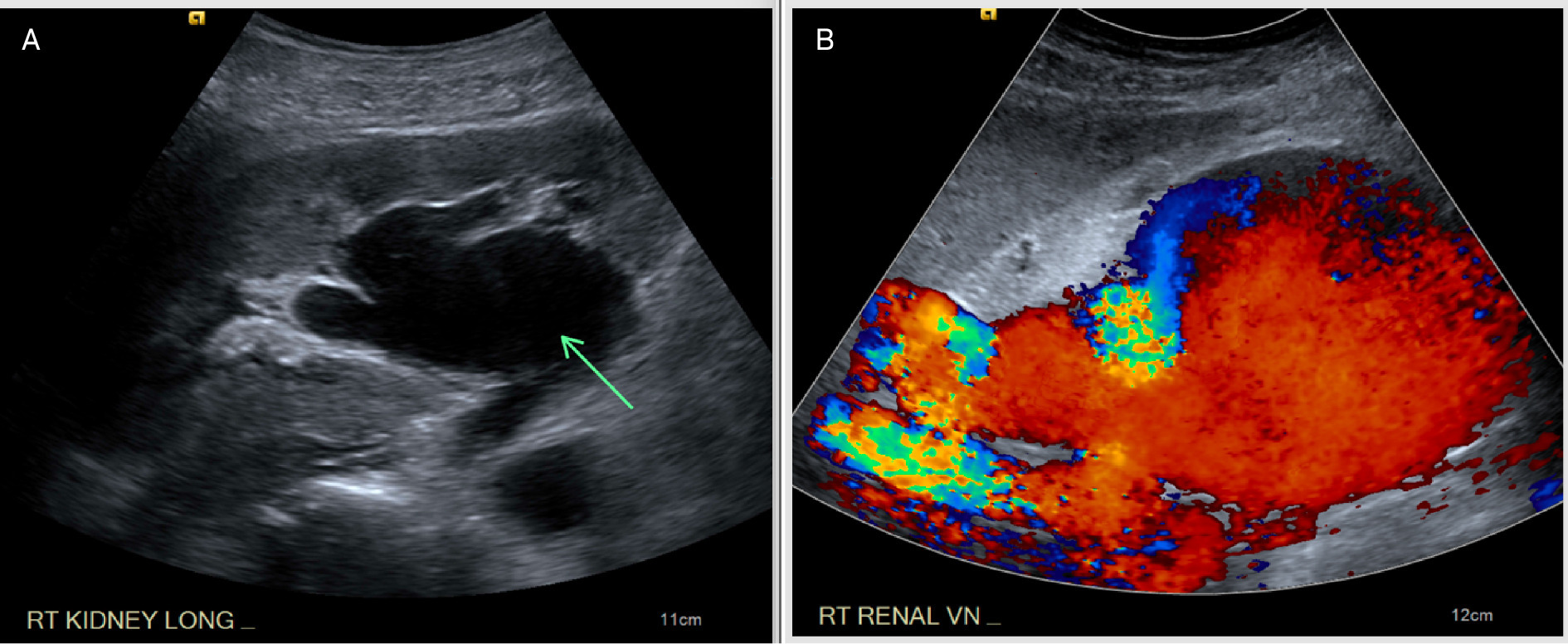 (A) Sagittal grayscale US of the right kidney demonstrating an anechoic region within the renal hilum (arrow) concerning for collecting system dilatation. (B) Sagittal US with color Doppler showing marked color Doppler flow in the same region. Turbulent flow is noted in the dilated renal vein.