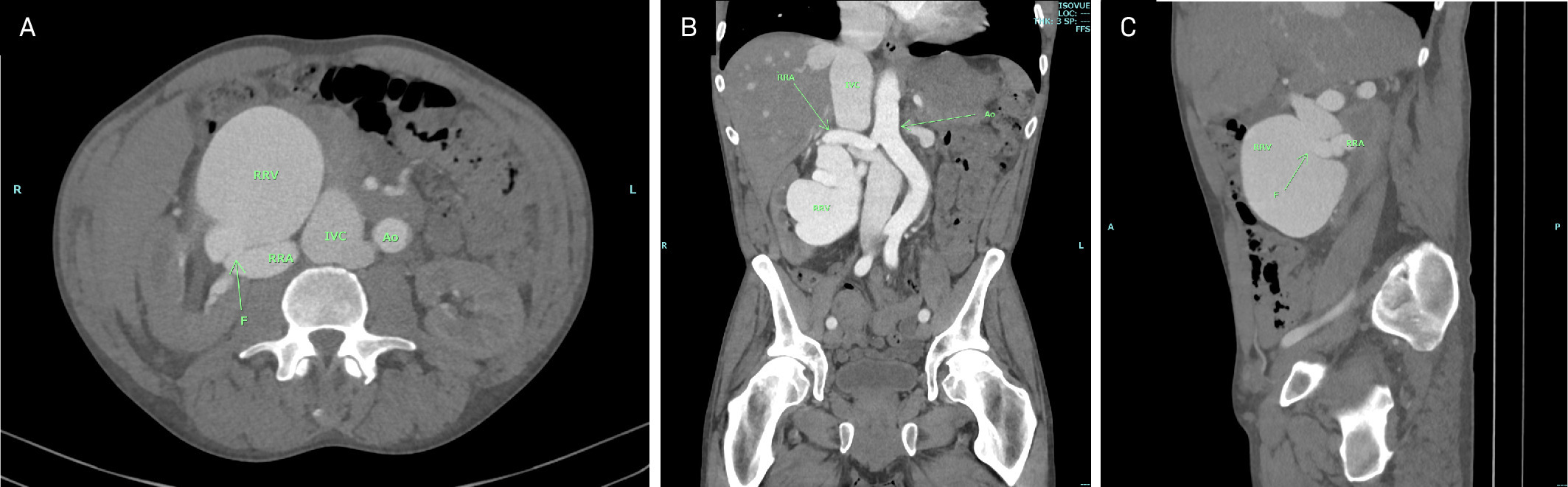 (A) Axial CTA image at the level of the mid right kidney demonstrating marked dilatation of the right renal artery (RRA), right renal vein (RRV), and inferior vena cava (IVC). Fistulous communication (F) is noted between the right renal artery and vein. (B) Coronal CTA image providing anatomic orientation with the aorta (Ao) and dilated RRA, RRV, and IVC. (C) Sagittal CTA image clearly depicting the fistula (F) between the RRA and RRV and the associated dilatation of these vessels.