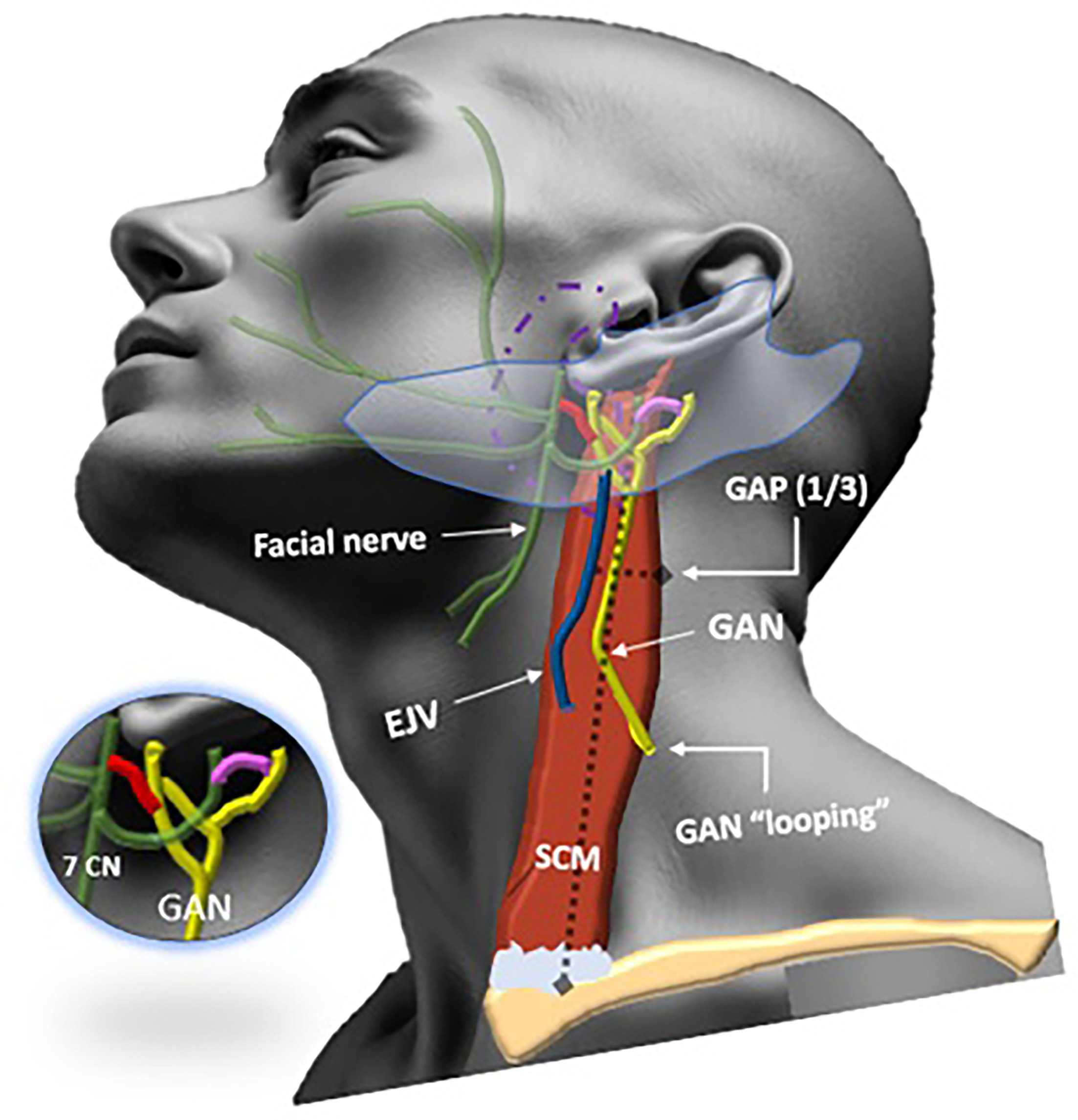 Illustration of the great auricular nerve (GAN) (yellow), showing its characteristic “looping” at the posterior border of the sternocleidomastoid muscle (SCM) (GAN looping). The nerve ascends superficially on the surface of the SCM, deep to the cervical fascia, approximately 1 cm posterior to the external jugular vein (EJV). It then divides into anterior (facial) and posterior (mastoid) branches, which supply the skin over the parotid gland (purple dotted outline) and the auricle, respectively (light blue shaded area). The anterior branch connects with the facial nerve (green), and the posterior branch connects with the auricular branch of the vagus nerve (not shown) and the posterior auricular branch of the facial nerve (pink) (zoomed insert). The great auricular point (GAP) is identified at one-third the distance from the mastoid process or external auditory canal to the clavicular origin of the SCM (black dotted lines). (Subject image is artificial intelligence-generated (magichour.ai); remainder of the drawing is by Osama Raslan, MD; used with permission.)