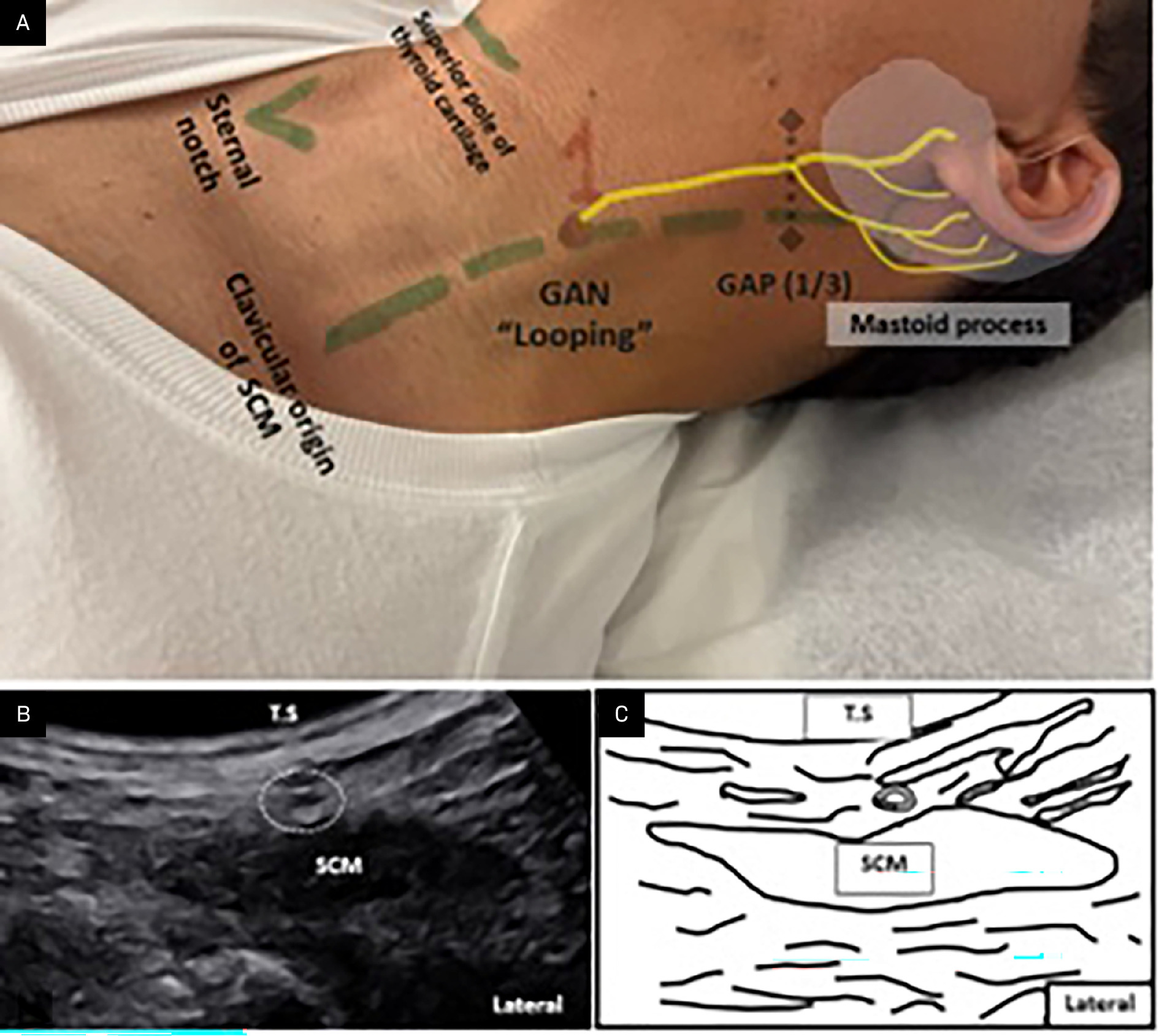 US of the greater auricular nerve (GAN). (A) With the patient in a supine or seated position and the head turned to the opposite side, identify key landmarks: the superior pole of the thyroid cartilage, the sternal notch, the clavicular origin of the sternocleidomastoid muscle (SCM), and its insertion at the mastoid process. The GAN emerges superficially at the “GAN-looping” point along the posterolateral border of the SCM and runs over the surface of the SCM to supply the skin over the lower auricle, parotid gland, and mastoid region (shaded white). The GAN can typically be found at approximately one-third the distance between the mastoid process (or external auditory canal) and the clavicular origin of the SCM. (B, C) Using a high-frequency superficial US probe (7‐13 MHz) and these anatomical landmarks, the GAN (circled) appears as a small hypoechoic structure running longitudinally over the SCM and curving under its posterolateral border to join the superficial cervical plexus.18-23