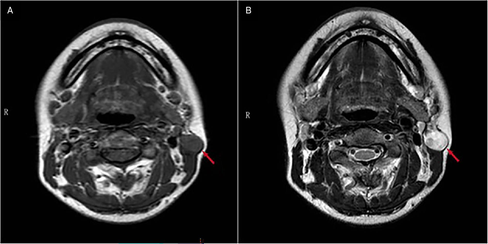 A 29-year-old woman presented with a slowly growing mass on the left side of the neck. MRI demonstrated a well-defined, rounded lesion situated on the superficial surface of the sternocleidomastoid muscle (SCM). The mass exhibited intermediate signal intensity on T1-weighted imaging (A) and inhomogeneous hyperintensity on T2-weighted imaging (B), with clearly defined margins (red arrow). The location of the lesion over the SCM and its imaging characteristics are suggestive of a great auricular nerve schwannoma. (Images reproduced with permission from Xu and Sun.)24