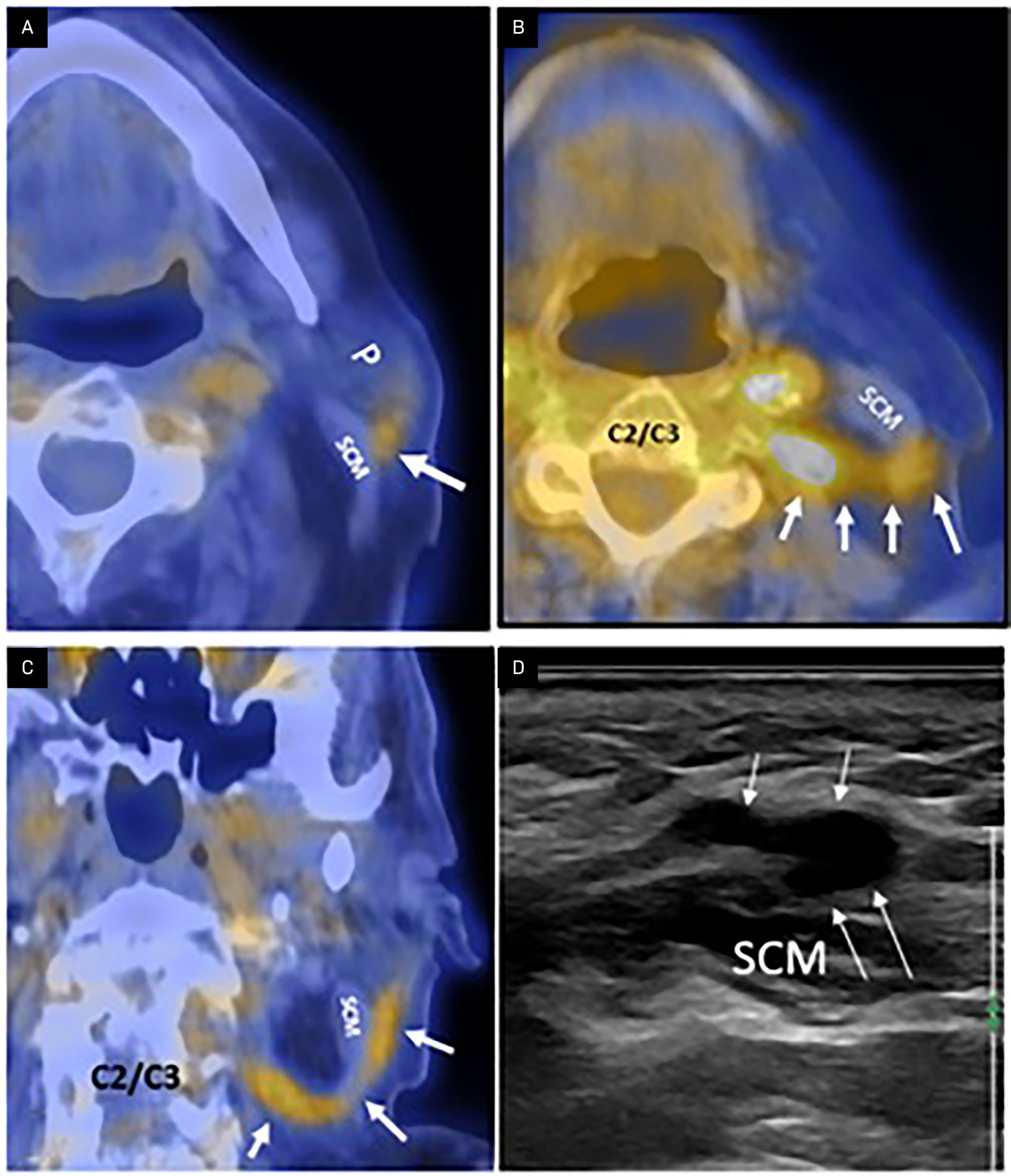 Axial FDG PET/CT images (A, B) at the level of the parotid gland demonstrate hypermetabolic tumor recurrence (arrows) on the surface of the parotid gland (P), extending inferiorly along the surface of the sternocleidomastoid muscle (SCM) (A), with a characteristic “looping point” at the posterior border of the SCM (B). Coronal oblique FDG PET/CT (C) shows a hypermetabolic, thickened left great auricular nerve (GAN) tumor (arrows) extending retrogradely from the parotid region inferiorly along the SCM surface, followed by the characteristic cranial loop beneath the SCM and ascension along the GAN toward the C2-3 neural exit foramen. (D) US demonstrates perineural spread involving the left GAN and its branches on the SCM surface (arrow). The lesion was misinterpreted as a superficial venous structure due to lack of familiarity, deep hypoechogenicity from high tumor cellularity, and the branching pattern along the nerve.