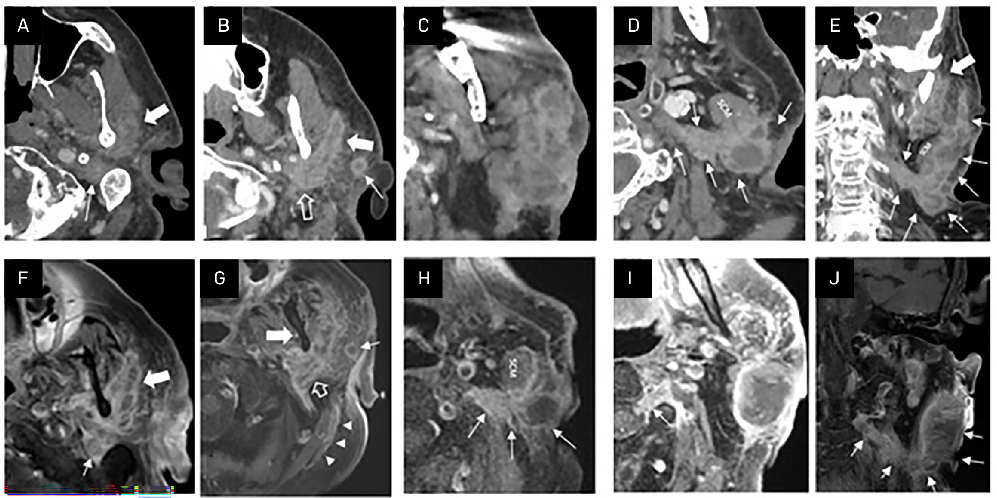 Axial (A-D) and coronal (E) contrast-enhanced CT, along with axial (G-J) and coronal (K) fat-saturated contrast-enhanced MRI images of the neck (arranged from superior to inferior), demonstrate extensive perineural tumor spread involving multiple cranial and cervical nerves. (A, G) Invasion of the facial nerve is evident at the stylomastoid foramen (thin arrow) and within the parotid gland (thick arrow). (B, H) Tumor extension is seen along the auriculotemporal branch toward the mandibular division of the trigeminal nerve (V3) (open arrow), with corresponding enhancement of V3 at the mandibular foramen on MRI (thick arrow in H). Invasion of the anterior branch of the great auricular nerve (GAN) is also noted (thin arrow). (C-D, I-J) Inferior sections reveal a confluent perineural mass along the GAN, with complete infiltration of the sternocleidomastoid muscle (SCM). The mass demonstrates the characteristic looping at the posterior border of the SCM (D, I) and ascends retrogradely through the C2-C3 neural foramen into the spinal canal (thin arrows in D-E and J-K).