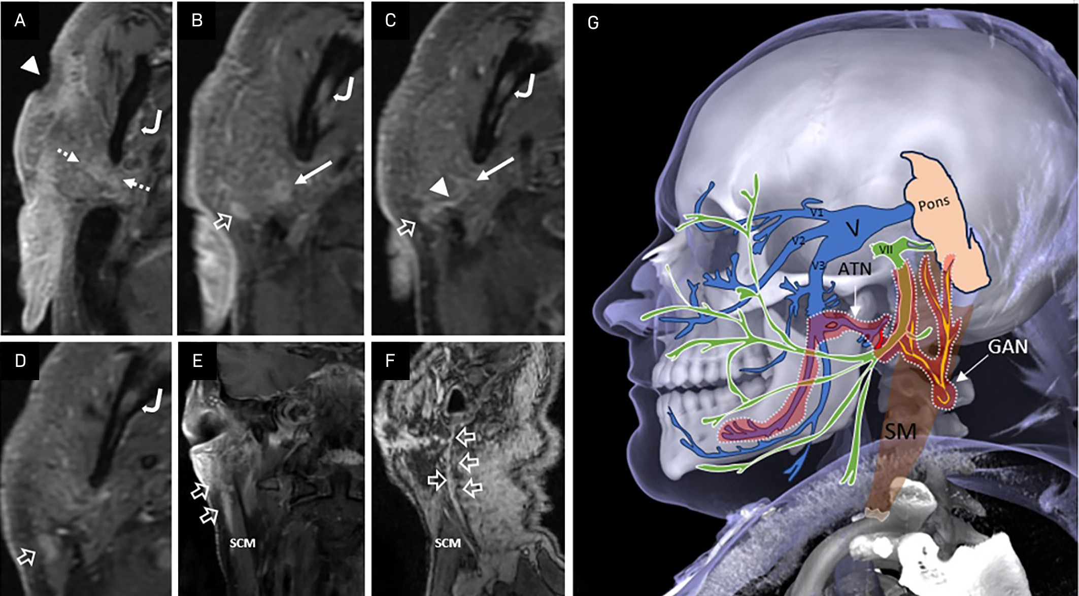 Axial (A-D, superior to inferior), coronal (E) post-contrast fat-suppressed T1-weighted images, and post-contrast oblique sagittal 3D FSPGR T1-weighted (F) MR images of the neck in an 81-year-old male patient. The images demonstrate a pathologically confirmed ulcerated cutaneous squamous cell carcinoma of the right cheek (arrowhead), with perineural invasion of the stylomastoid segment of the right facial nerve (long white arrow). The tumor extends to involve the right auriculotemporal nerve (ATN) (thick dashed arrow, A), the inferior alveolar branch of the trigeminal nerve (V3) (curved arrow, A-D), and the greater auricular nerve (GAN) (empty white arrow, B-F). Note the enhancing anterior branch of the GAN in panel (C), which connects to the facial nerve. (G) A diagrammatic representation illustrates a contiguous perineural tumor spread, highlighted by orange shading. The spread extends from the stylomastoid segment of the facial nerve (cranial nerve VII, green) through the ATN (blue) to the trigeminal nerve (cranial nerve V), including invasion of the inferior alveolar branch of the mandibular division (V3, blue). Additionally, tumor extension is depicted from the facial nerve to the GAN (yellow) via its anterior division connection.