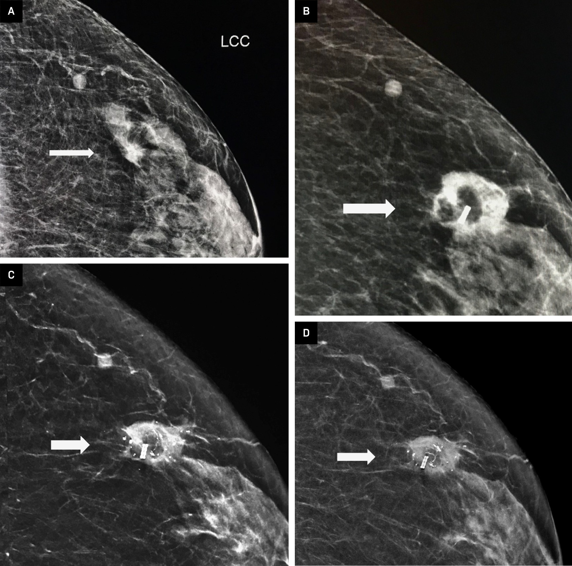 (A) Imaging findings, left craniocaudal (LCC) view, of a patient from the ICE3 trial, showing a 6-mm invasive ductal carcinoma prior to cryoablation (arrow). (B) 12 months post ablation. Note the formation of a thickened rim of dense tissue around the ablation zone (arrow). (C) 36 months post ablation. The rim of dense tissue remains, and there has been interval development of dystrophic calcifications (arrow). (D) 60 months post ablation. The dystrophic calcifications persist and have increased over time. The rim of dense tissue has become less dense (arrow).