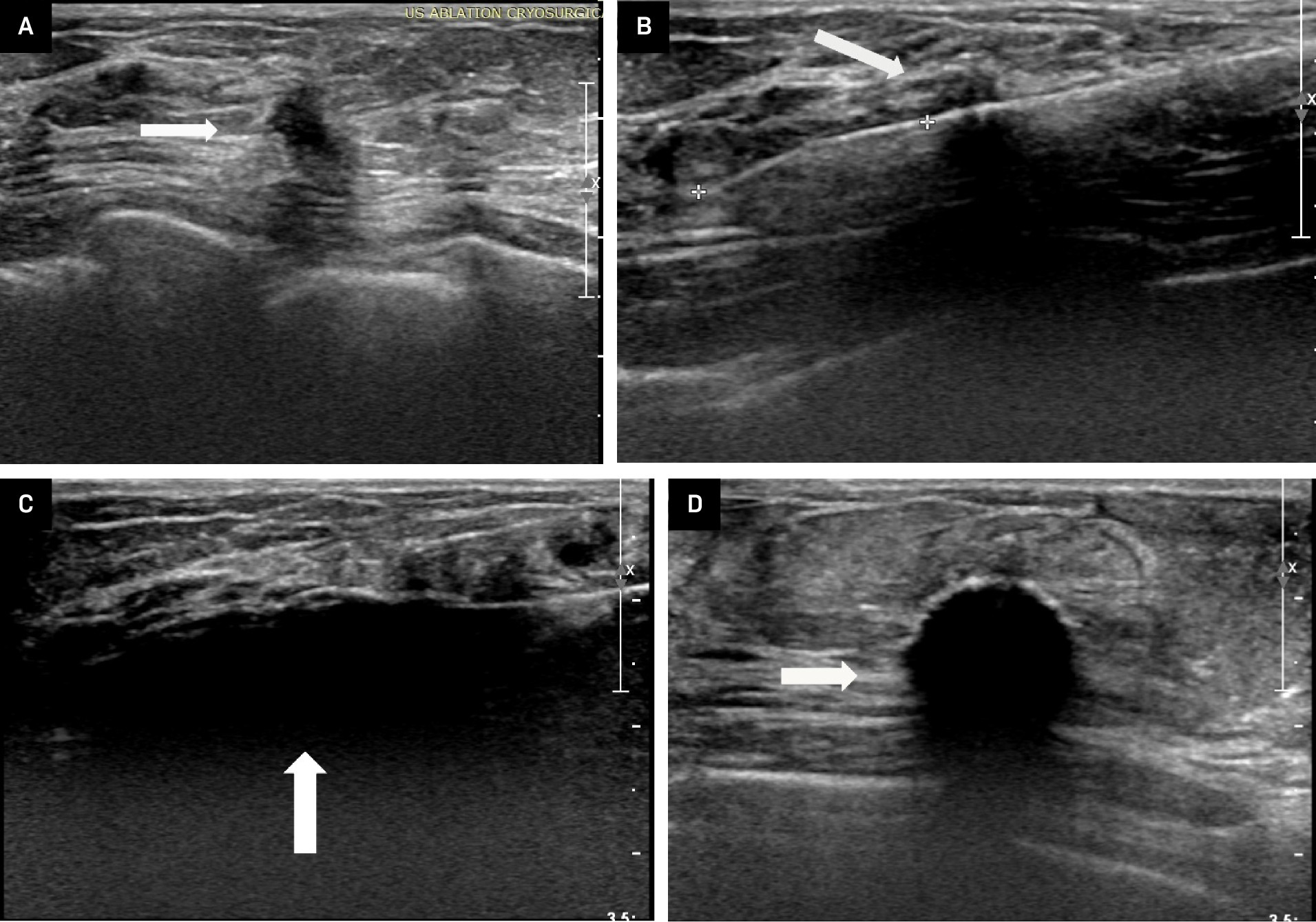 (A) US image of the same patient as in Figure 1. Post biopsy, pre-ablation US demonstrates an irregular, poorly marginated hypoechoic mass (arrow). (B) US image with cryoprobe (echogenic line) through the center of the mass (arrow). Calipers present defining the ideal distance from the tip of the probe to the anterior border of the lesion for optimal cryosphere formation. (C) Early cryosphere formation in the longitudinal plane. (D) Early cryosphere formation in the transverse plane.