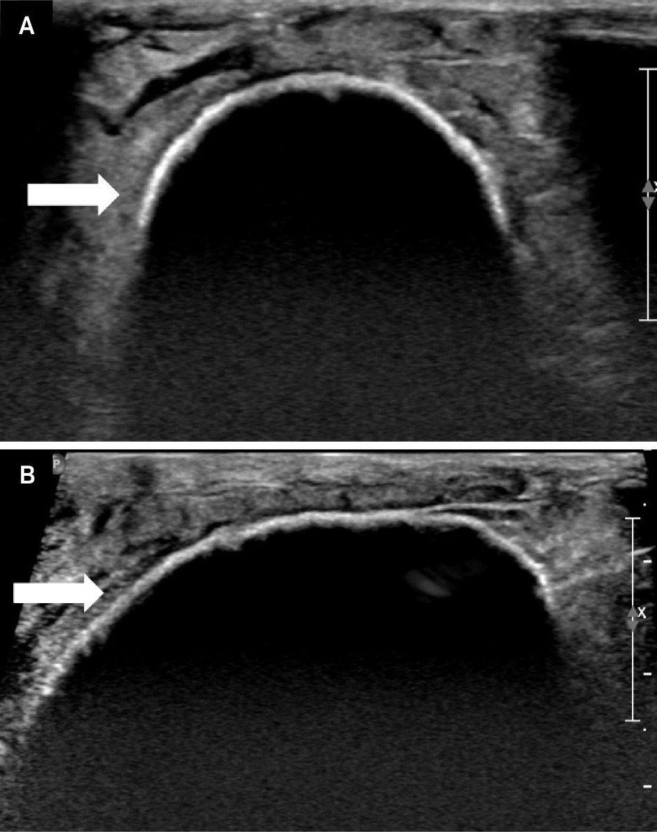 (A) Image of the same patient as in Figure 1. Highly visible, nearly anechoic cryosphere with echogenic border (arrow) in the transverse plane. (B) Highly visible nearly anechoic cryosphere with echogenic border (arrow) in the longitudinal plane.