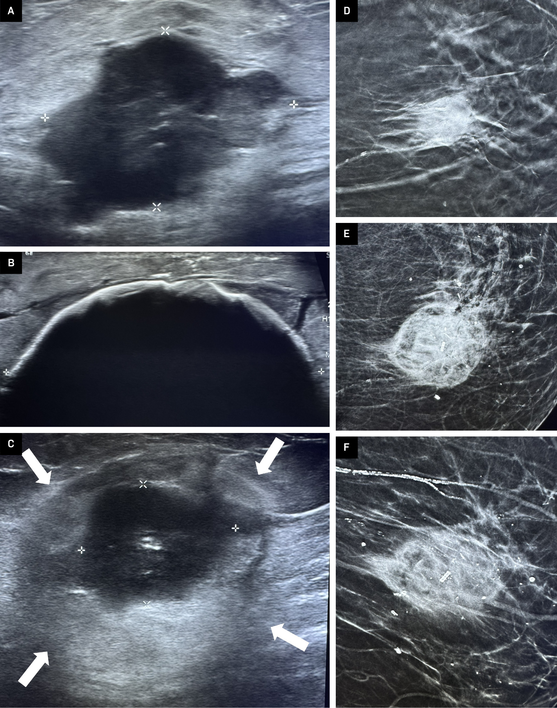 (A) Irregular poorly marginated mass in a 90-year-old patient with multiple comorbidities measuring 3.4 cm × 2.4 cm. (B) Mass completely engulfed by 5.7 cm cryosphere post ablation using 3 freeze-thaw-freeze cycles and a single cryoprobe. (C) Hypoechoic mass “ghost” (centrally) of treated tumor 3 months post ablation measuring 2.6 cm × 2.0 cm. Note the echogenic rim “cryohalo” defining the ablation zone margin (arrows). (D) Mammography of mass pre ablation. (E) Mammography of mass 3 months post ablation. Note the larger appearance due to inflammatory response in surrounding tissue following cryoablation. (F) Mammography of mass 18 months post ablation. Decreased density and size of mass with formation of some dystrophic calcifications.