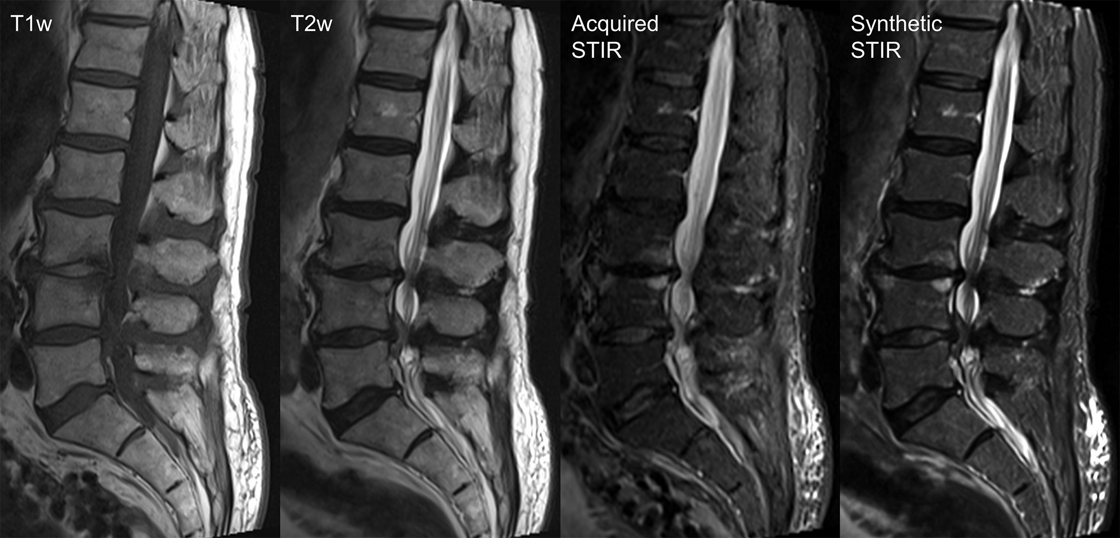 Example of an artificial intelligence algorithm that generates a synthetic Short Tau Inversion Recovery (STIR) sequence from sagittal T1-weighted and T2-weighted spine MRI. The synthetic STIR image shows comparable depiction of vertebral pathology and edema to the acquired STIR image.