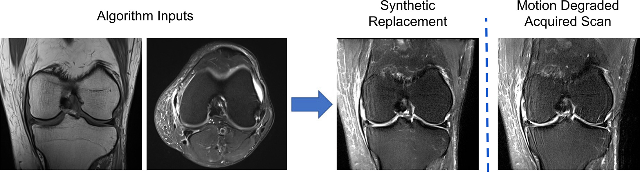When a sequence is degraded by patient motion (right), information from other sequences acquired during the same exam can be used to synthesize a replacement image, eliminating the need for rescanning.