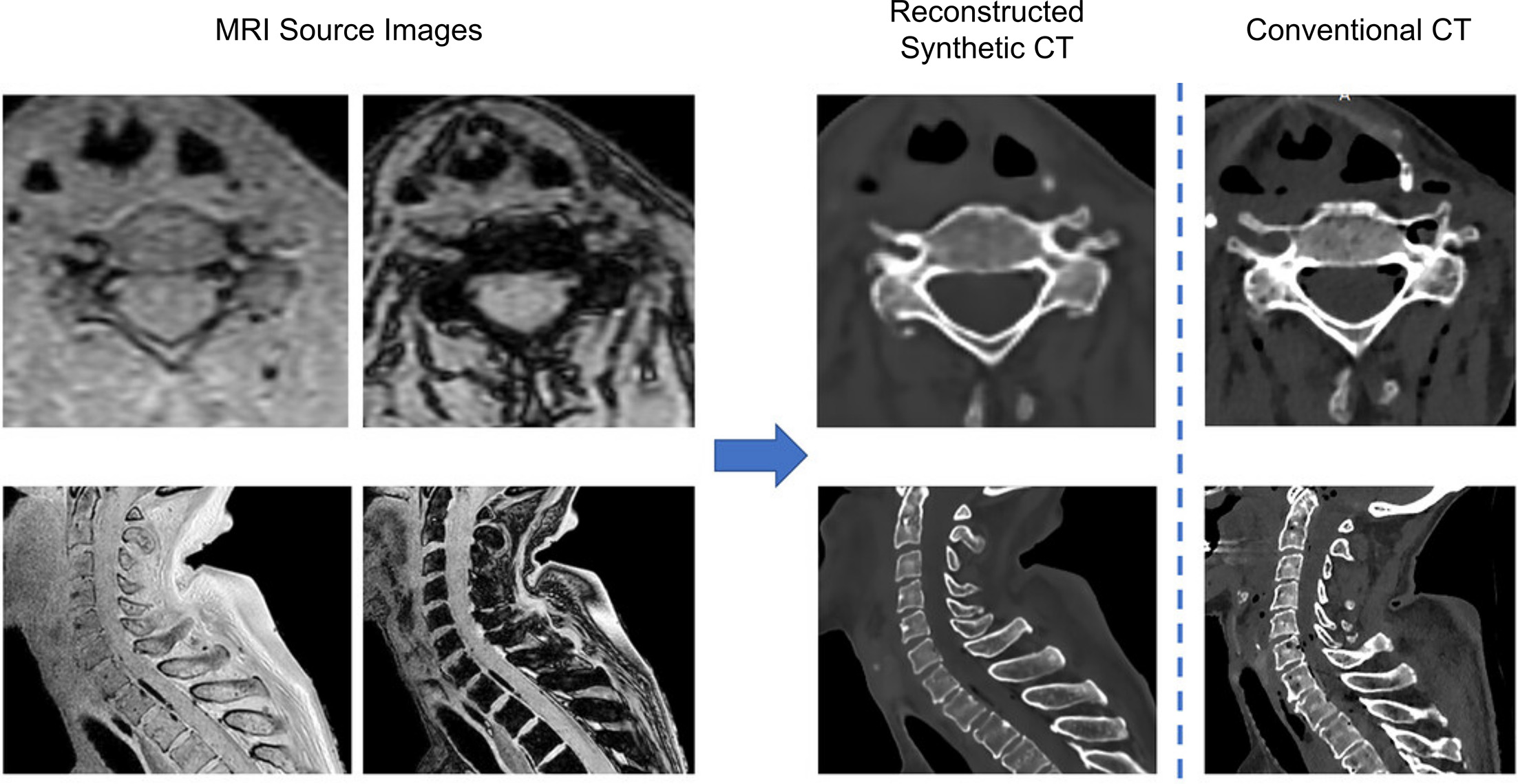 Examples of conventional CT and MRI-based synthetic CT images. Synthetic CT can provide CT-like anatomical information for surgical planning while avoiding additional ionizing radiation exposure, particularly in pediatric patients. Reprinted under Creative Commons license 4.0 from the Journal of Neurosurgery: Spine.2