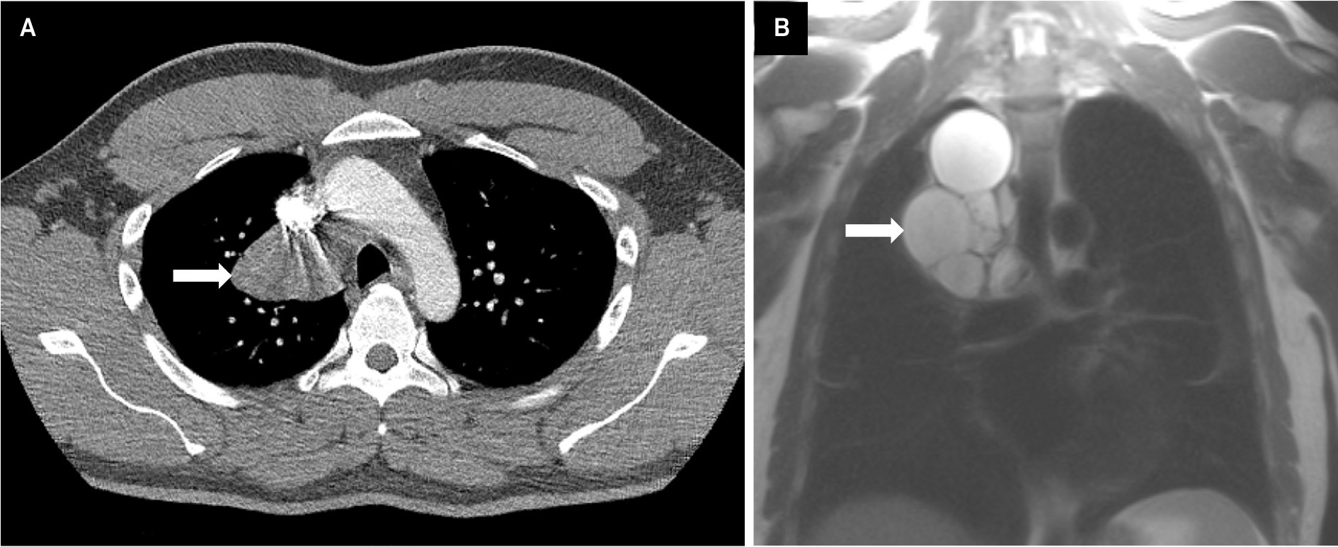Bronchogenic cyst. (A) Axial contrast-enhanced CT image demonstrates a well-defined, thin-walled, low-attenuation cystic lesion in the visceral mediastinum superior to the right main stem bronchus. (B) Coronal T2 MRI sequence shows a multilobulated hyperintense lesion superior to the right main stem bronchus with tissue characteristics of a simple bronchogenic cyst.